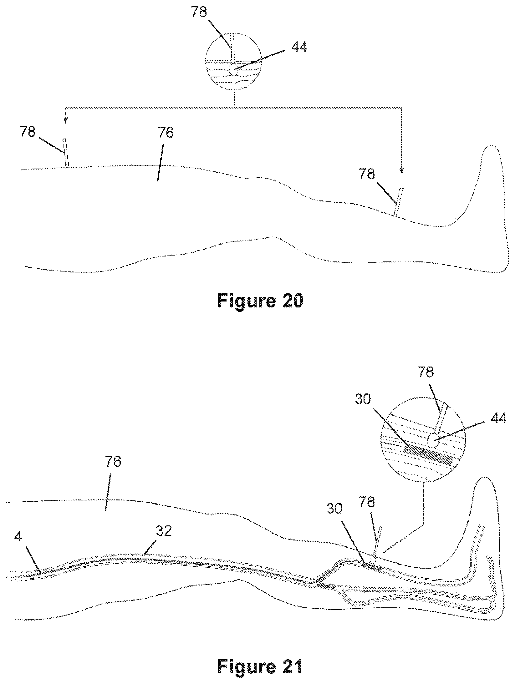 Patent US12376826 Figure 11 – Determining the condition of vessels in the body