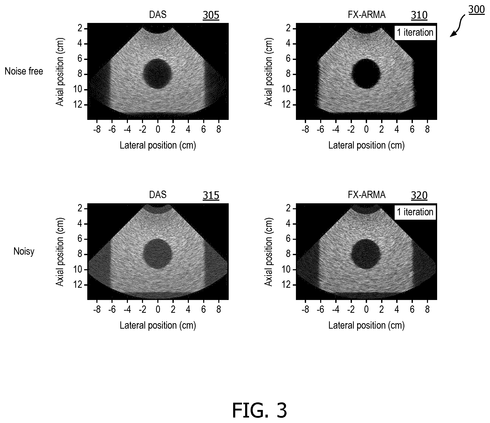 Patent US12376833 Figure 3 – Methods and systems for random noise supression and filtering of acoustic clutter via autoregressive moving average filter