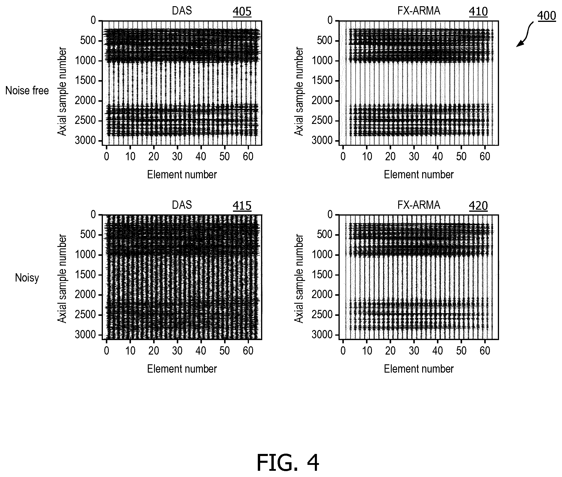 Patent US12376833 Figure 4 – Methods and systems for random noise supression and filtering of acoustic clutter via autoregressive moving average filter