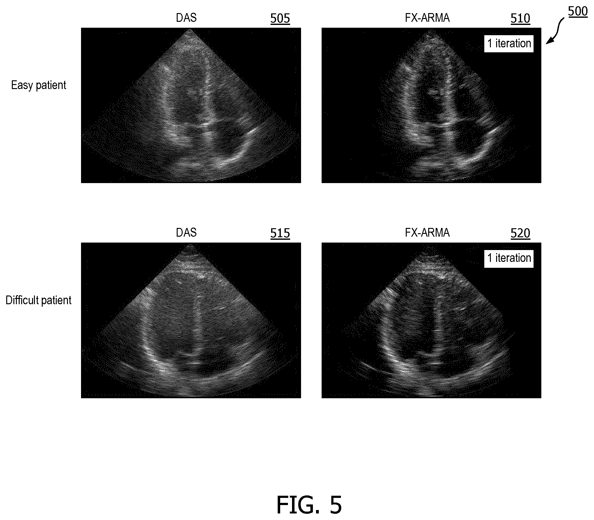 Patent US12376833 Figure 5 – Methods and systems for random noise supression and filtering of acoustic clutter via autoregressive moving average filter