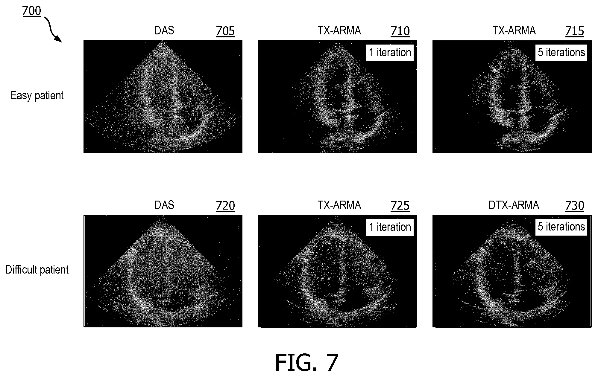 Patent US12376833 Figure 7 – Methods and systems for random noise supression and filtering of acoustic clutter via autoregressive moving average filter