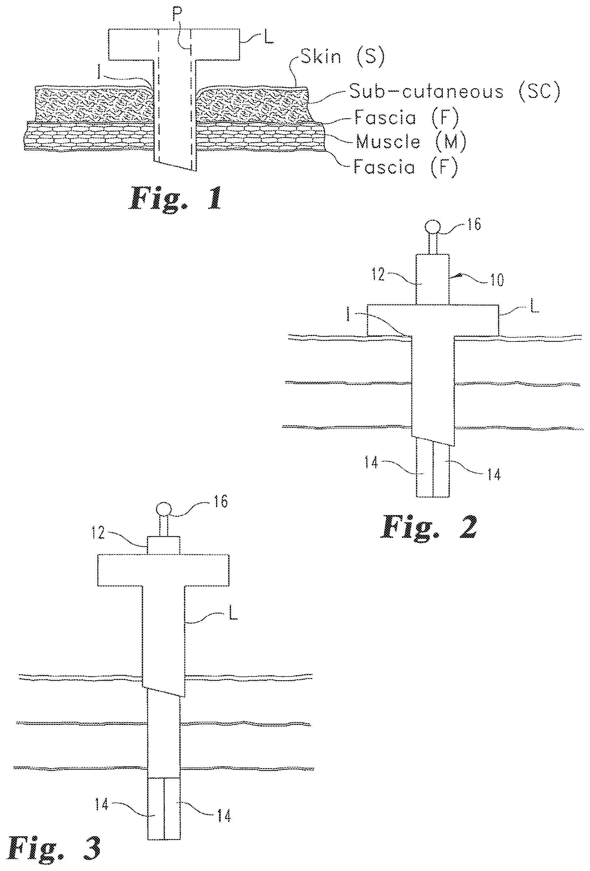 Patent US12376839 Figure 1 – Laparoscopic port site closure tool