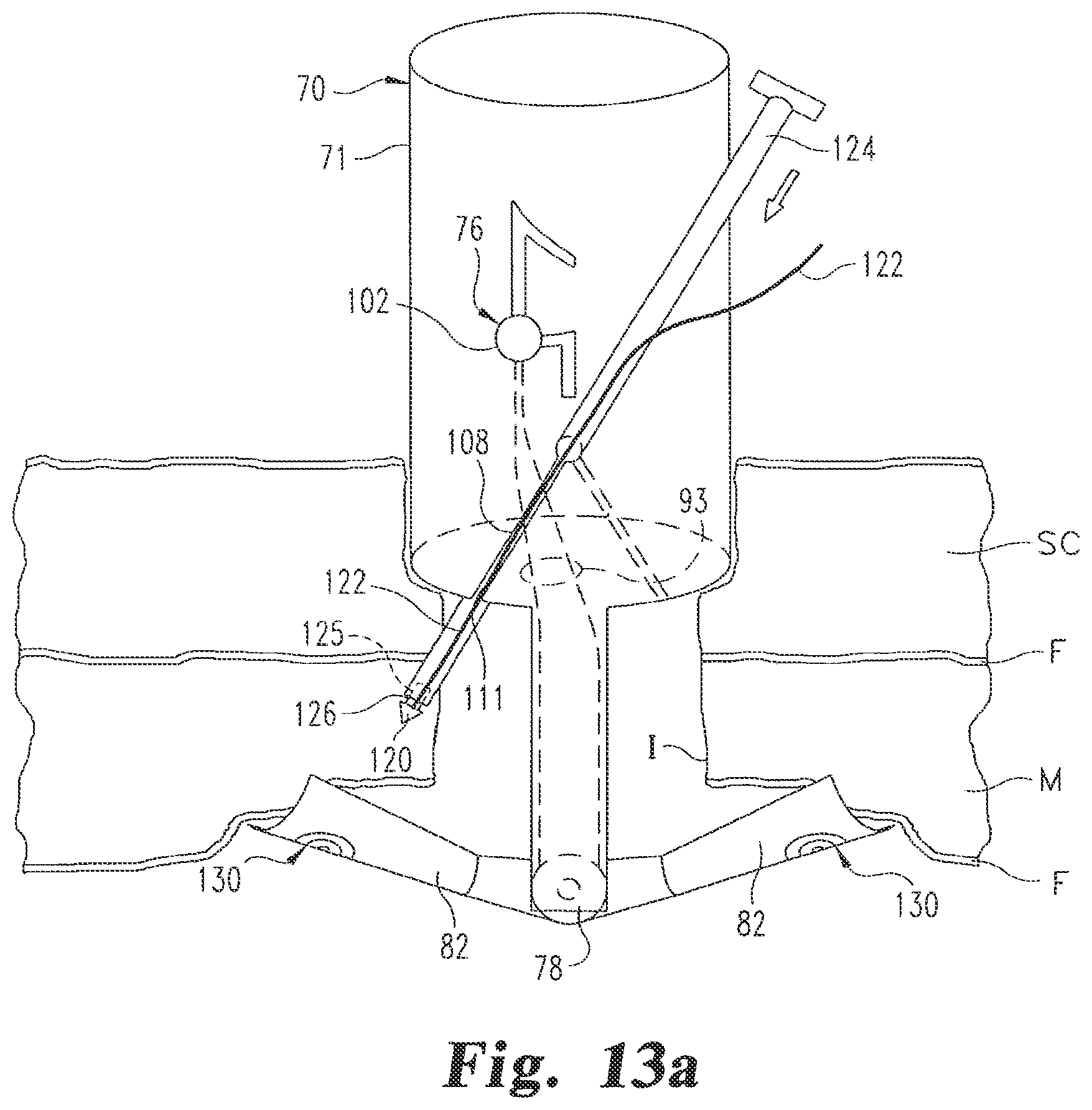 Patent US12376839 Figure 7 – Laparoscopic port site closure tool