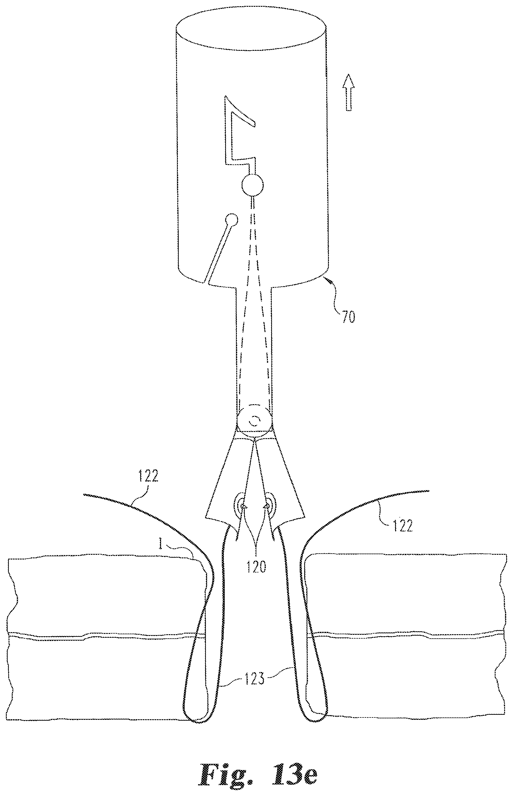 Patent US12376839 Figure 11 – Laparoscopic port site closure tool