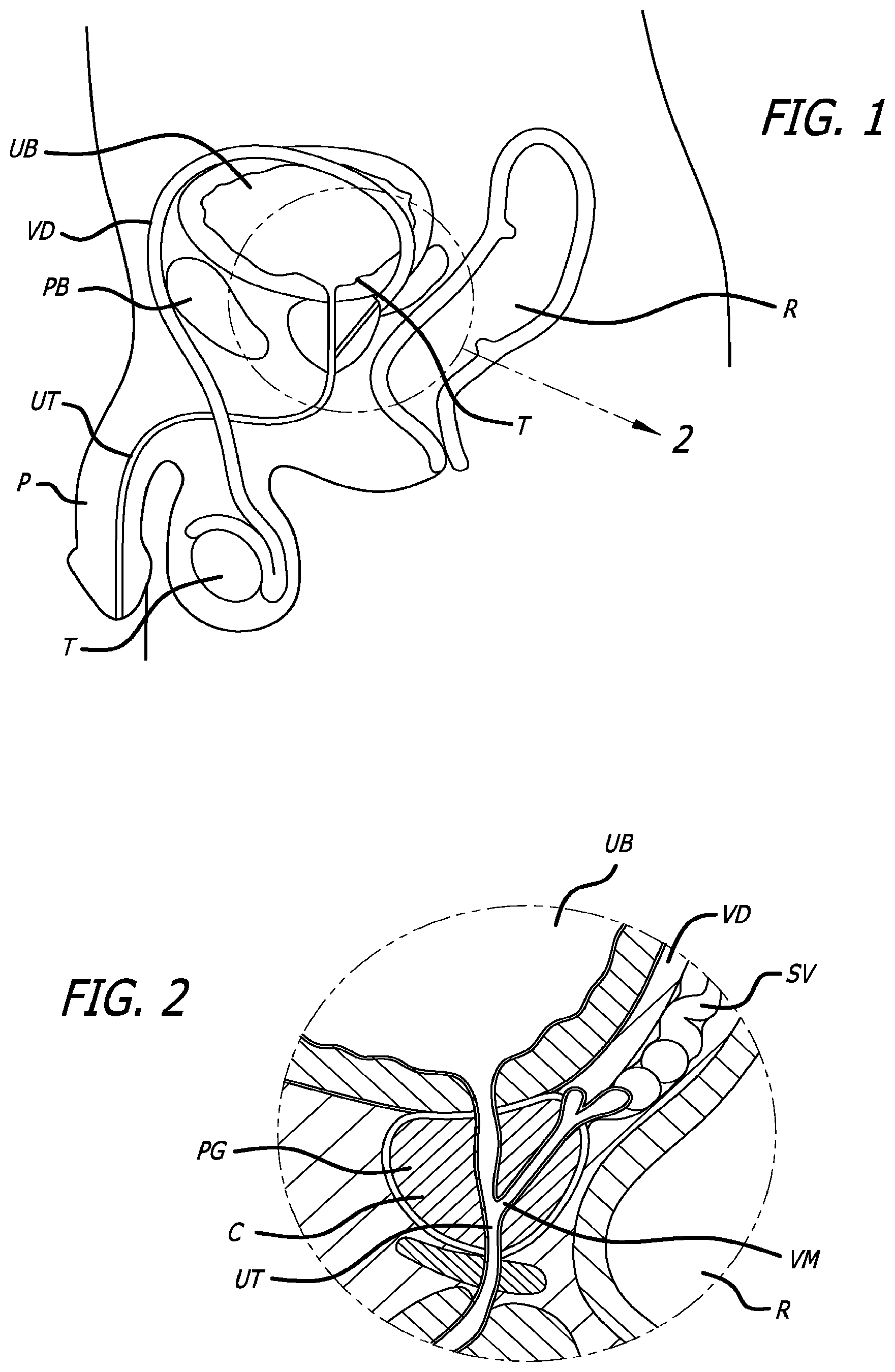 Patent US12376842 Figure 1 – Flexible system for delivering an anchor