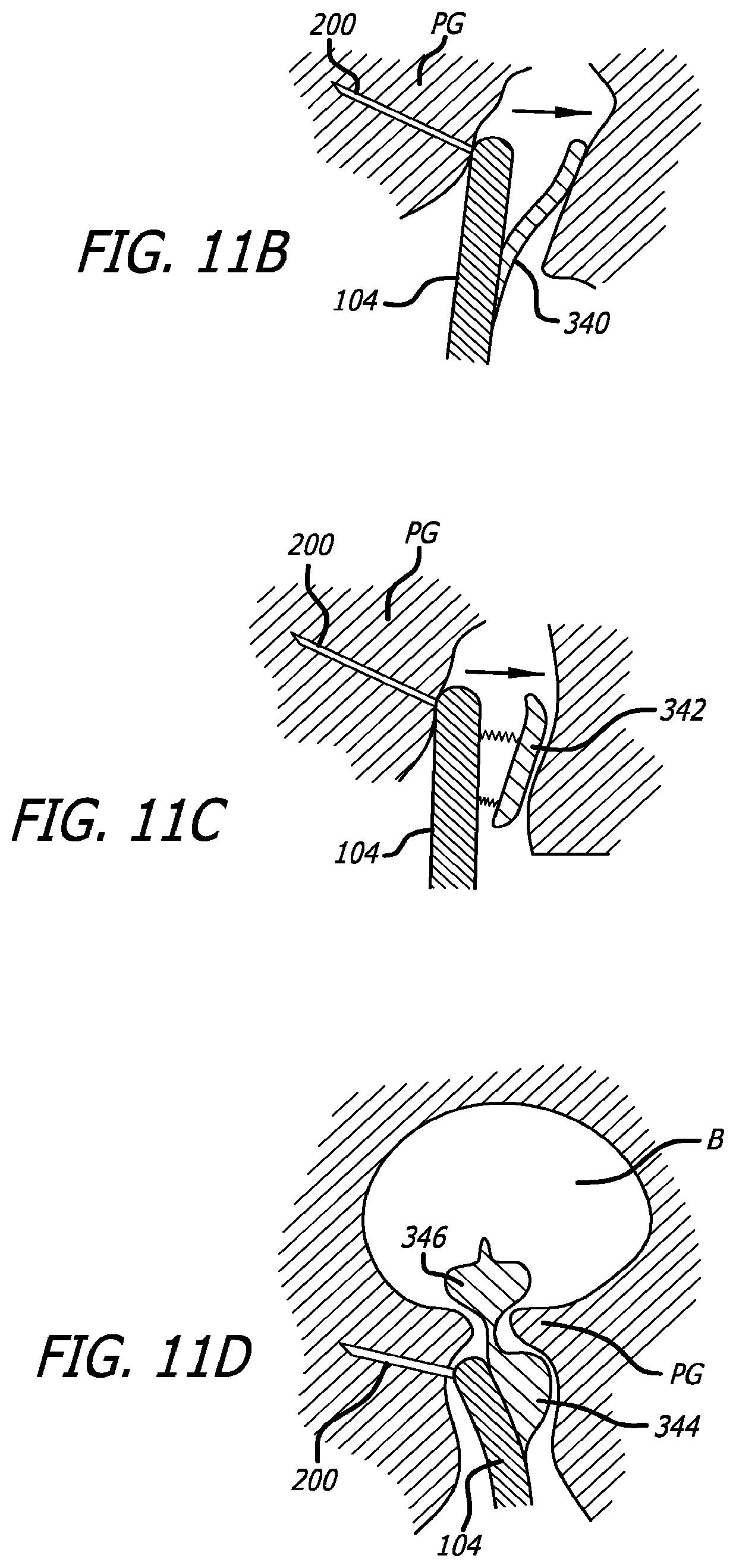 Patent US12376842 Figure 12 – Flexible system for delivering an anchor
