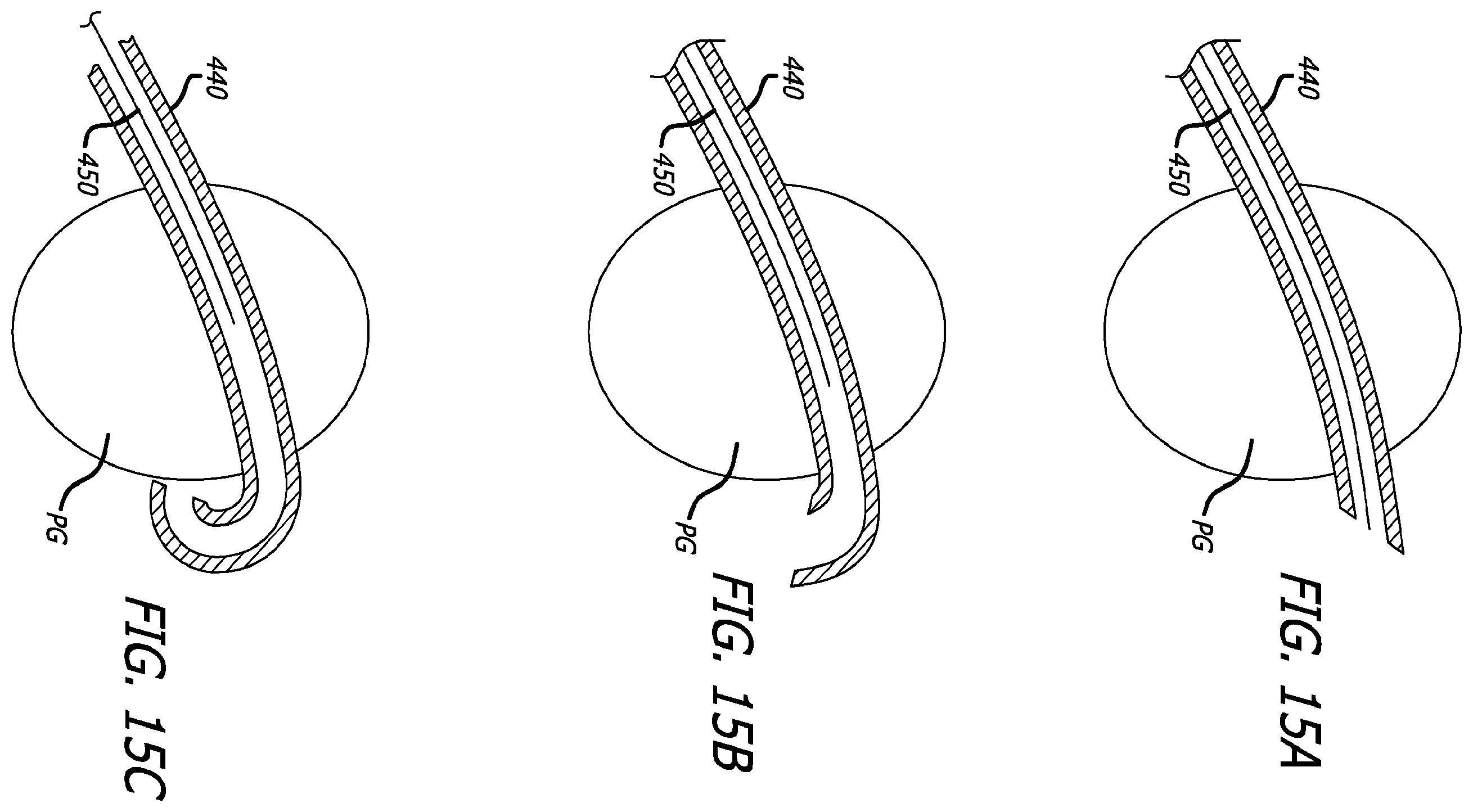 Patent US12376842 Figure 16 – Flexible system for delivering an anchor