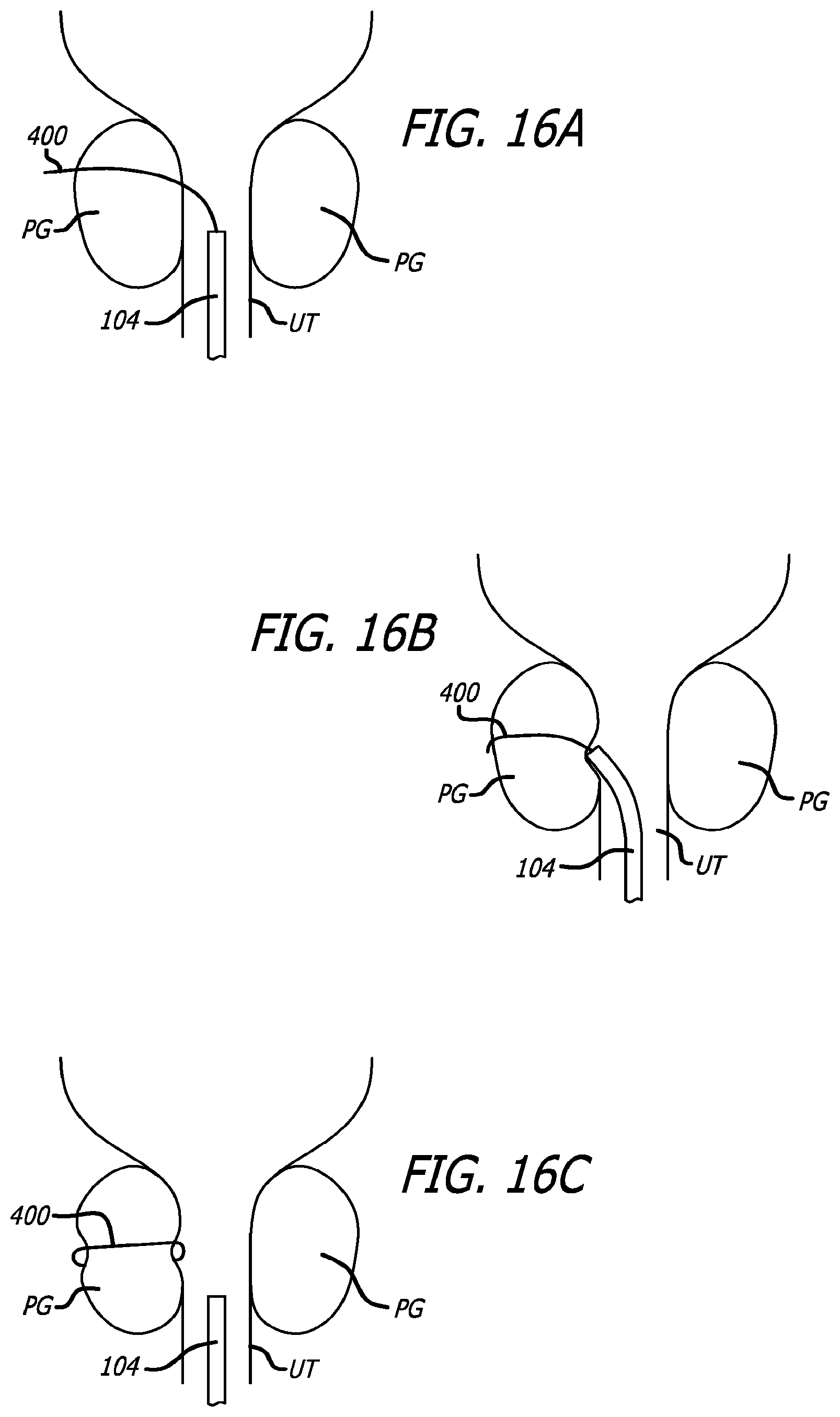 Patent US12376842 Figure 17 – Flexible system for delivering an anchor