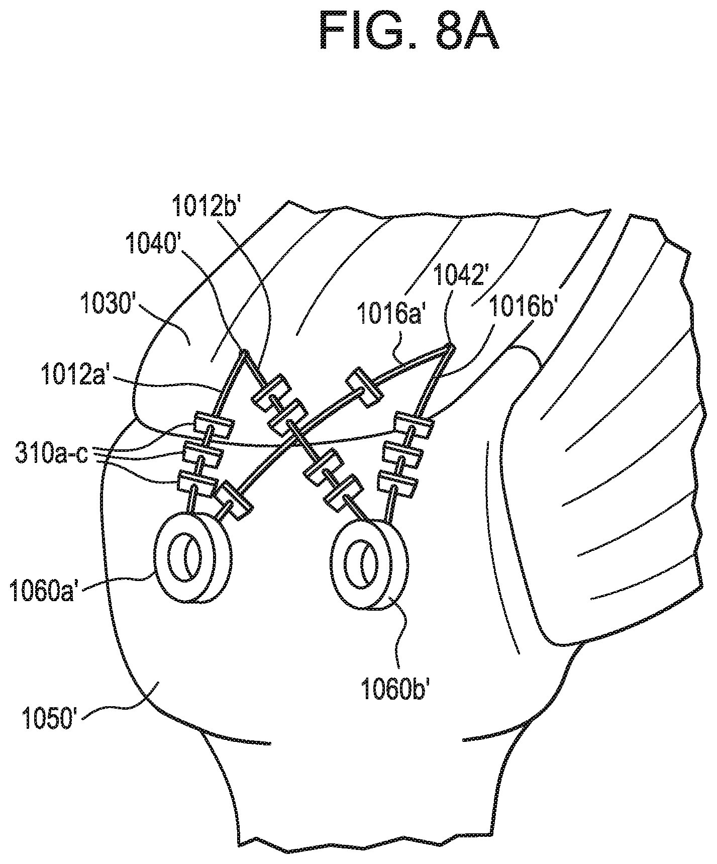 Patent US12376843 Figure 12 – Tissue augmentation tacks for use with soft tissue fixation repair systems and methods