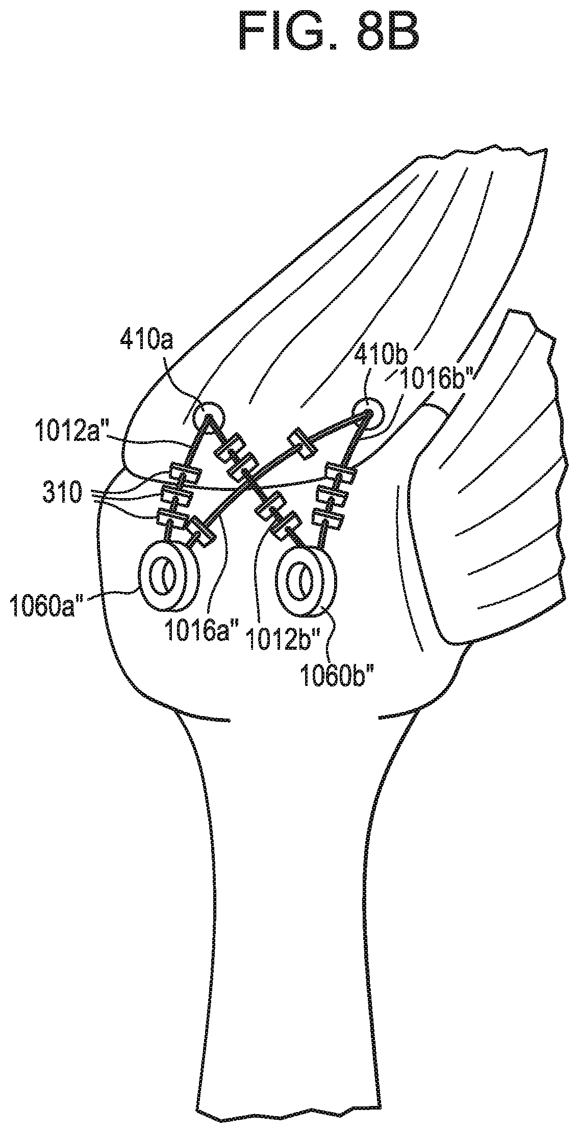 Patent US12376843 Figure 13 – Tissue augmentation tacks for use with soft tissue fixation repair systems and methods