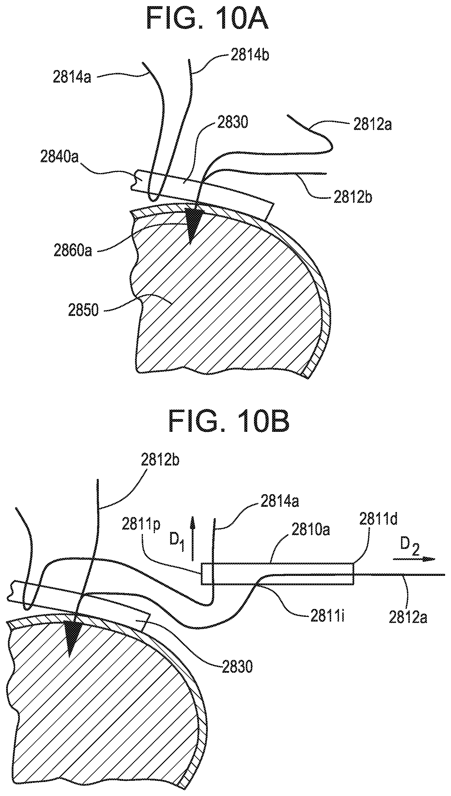 Patent US12376843 Figure 15 – Tissue augmentation tacks for use with soft tissue fixation repair systems and methods
