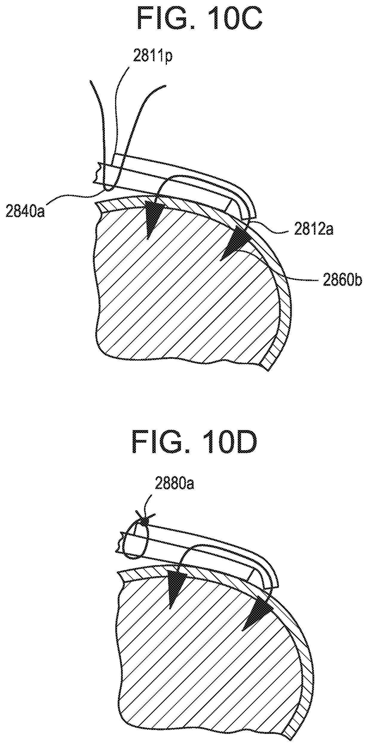 Patent US12376843 Figure 16 – Tissue augmentation tacks for use with soft tissue fixation repair systems and methods