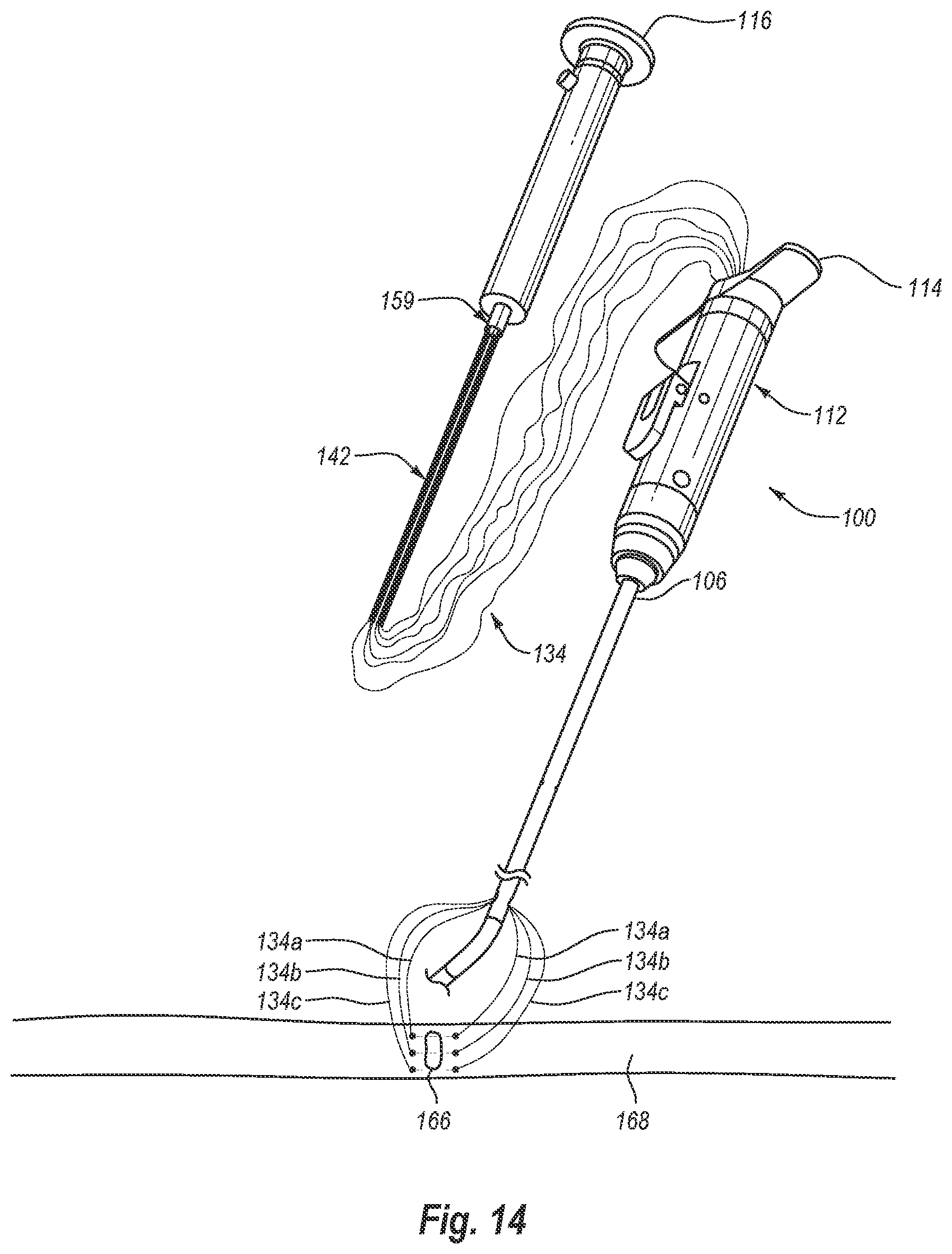 Patent US12376845 Figure 17 – Systems, methods, and devices for closing holes in body lumens