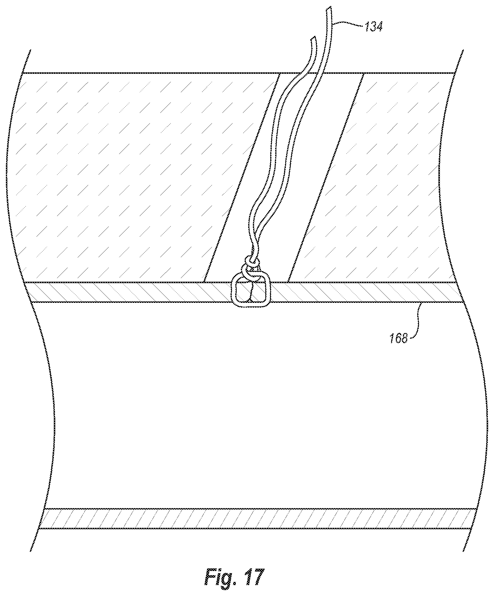 Patent US12376845 Figure 20 – Systems, methods, and devices for closing holes in body lumens