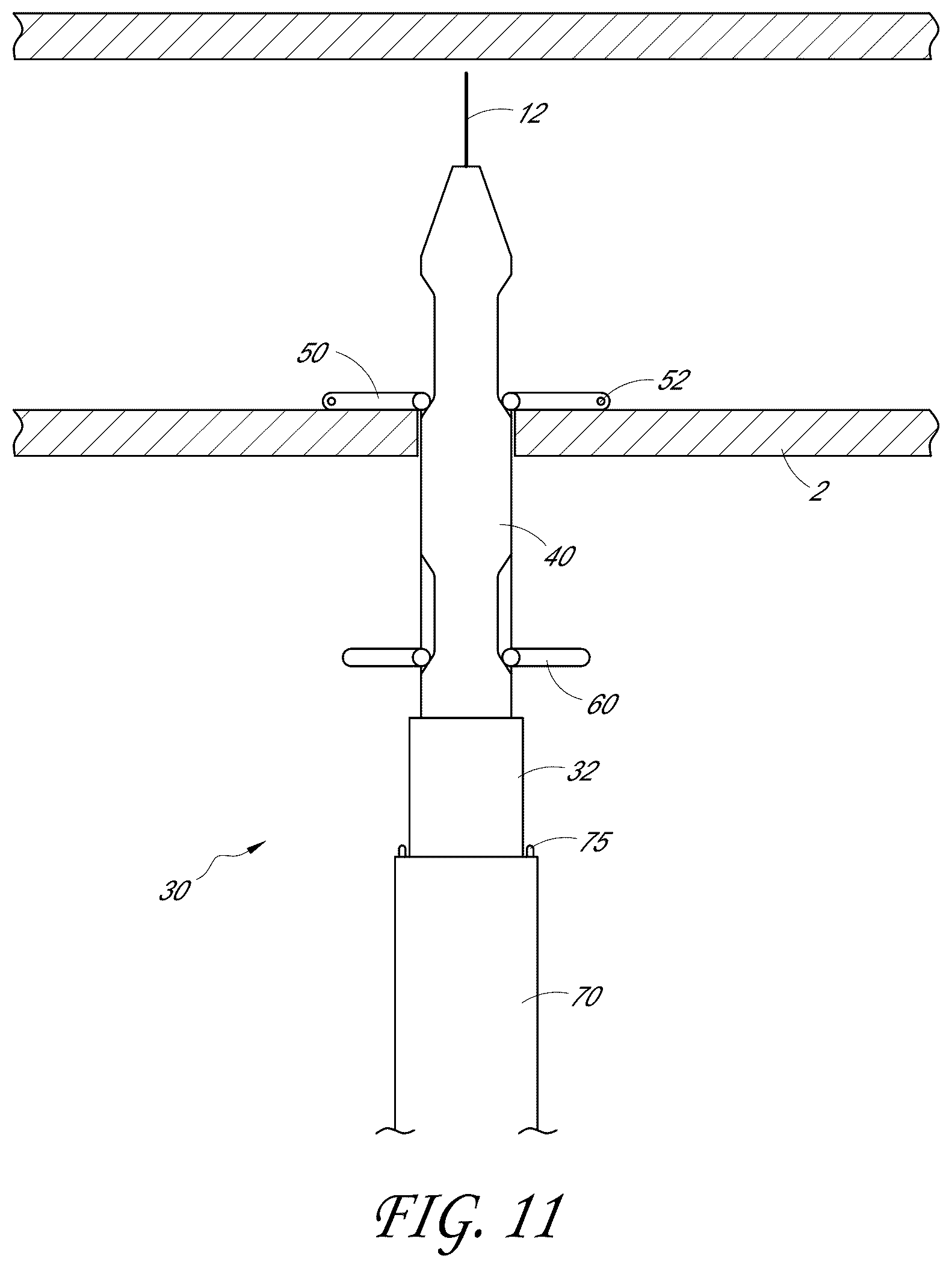 Patent US12376846 Figure 11 – Suturing devices and methods for suturing an anatomic structure
