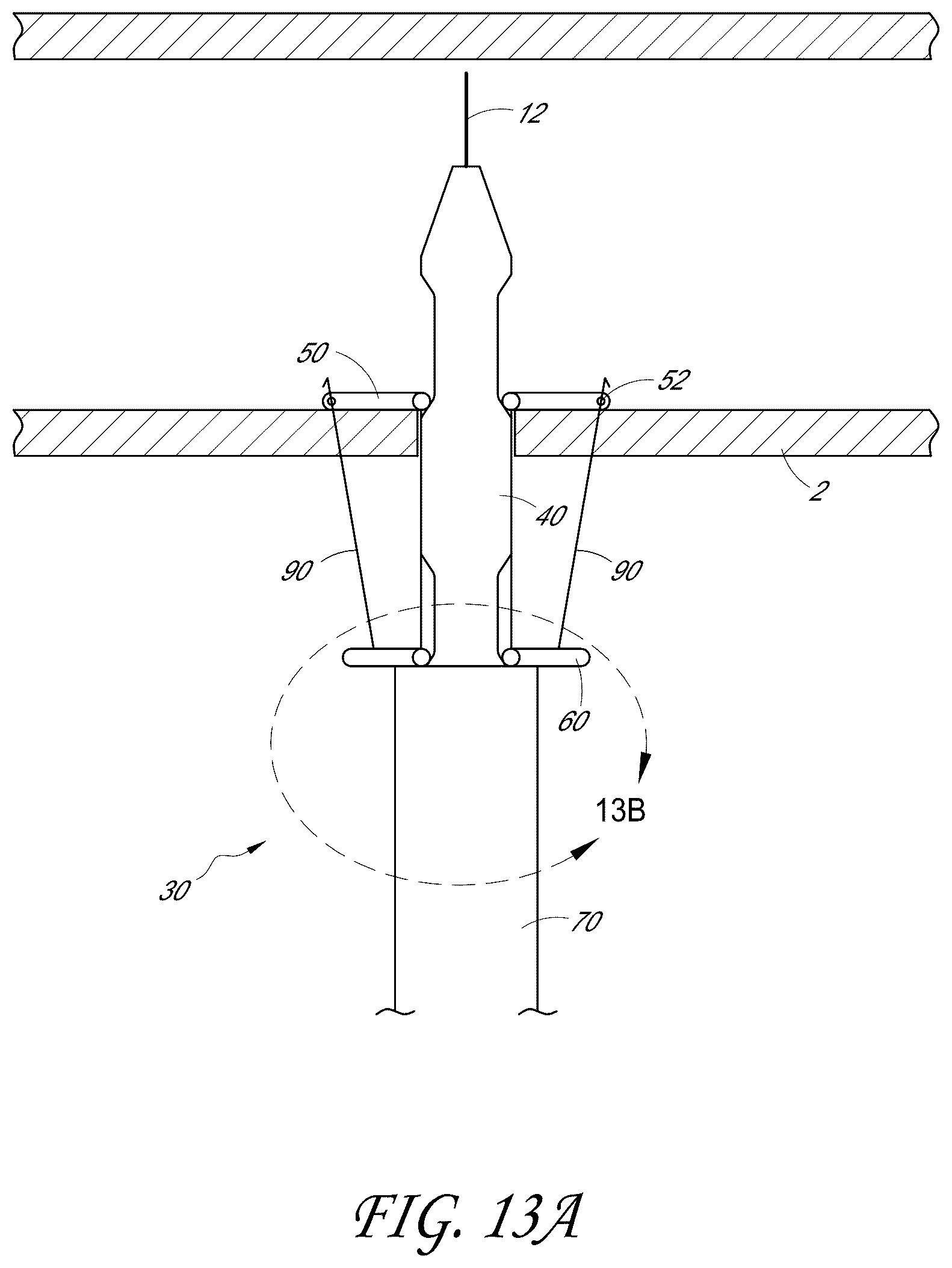 Patent US12376846 Figure 13 – Suturing devices and methods for suturing an anatomic structure