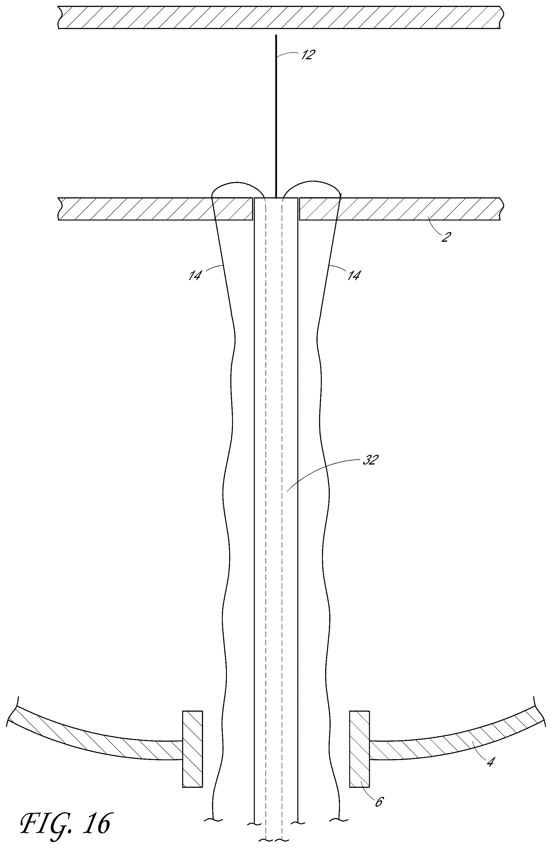 Patent US12376846 Figure 17 – Suturing devices and methods for suturing an anatomic structure