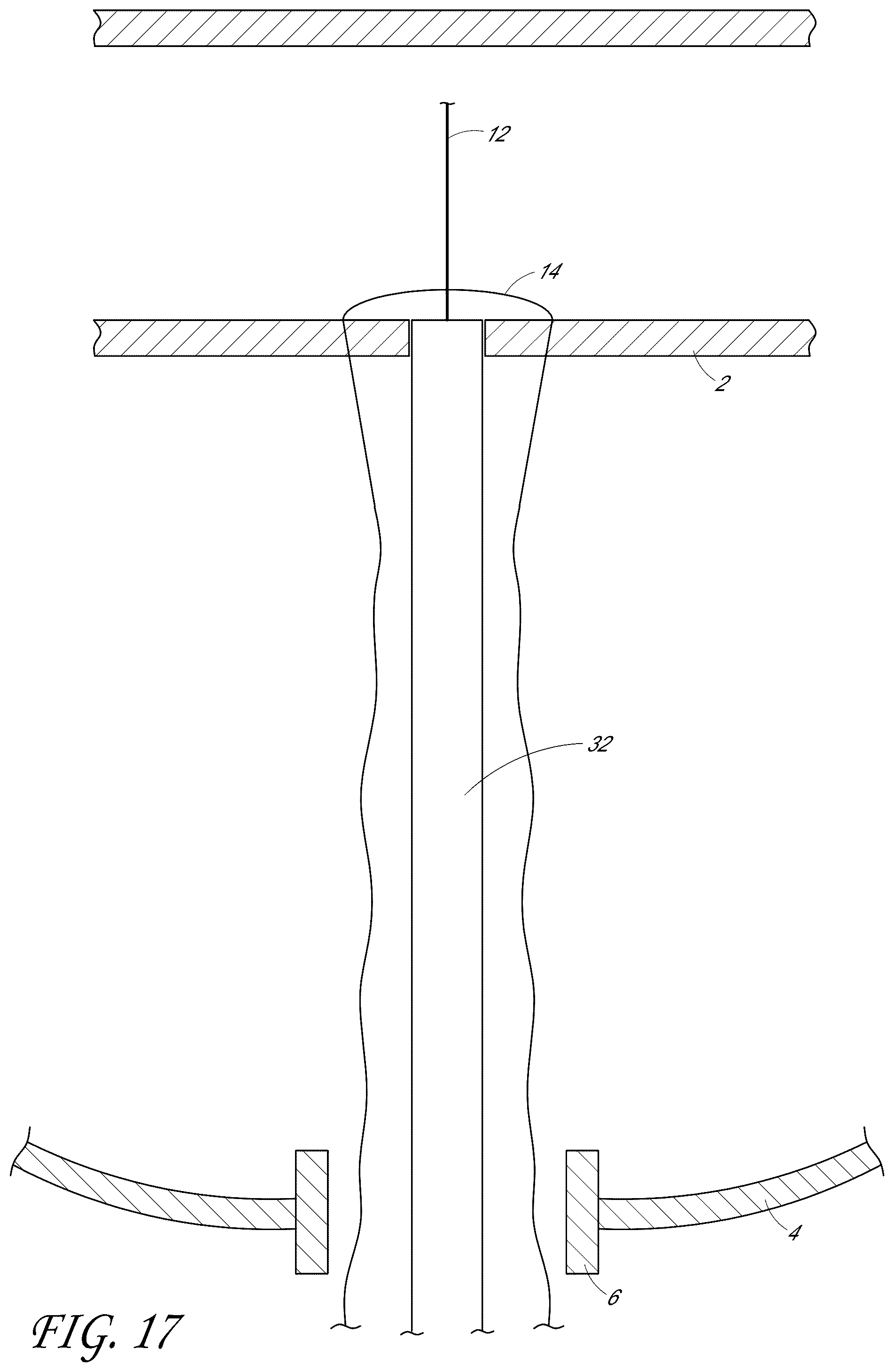 Patent US12376846 Figure 18 – Suturing devices and methods for suturing an anatomic structure