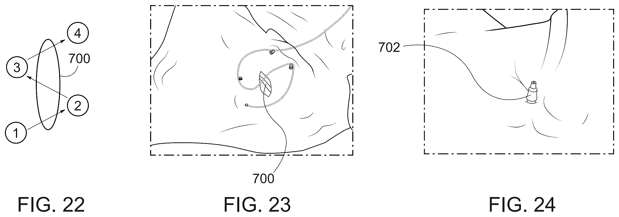Patent US12376847 Figure 14 – Endoscopic tissue approximation system and methods