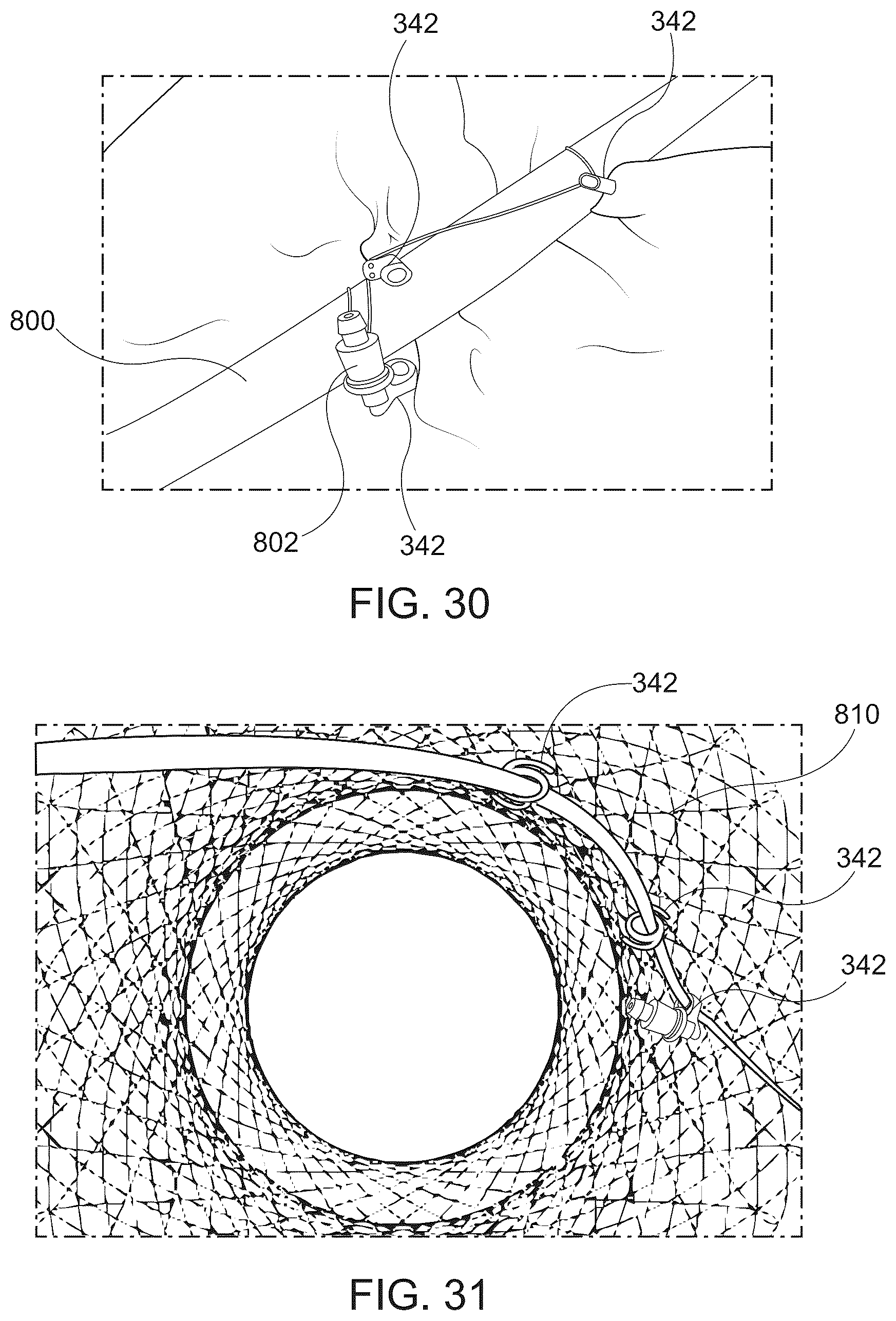 Patent US12376847 Figure 16 – Endoscopic tissue approximation system and methods