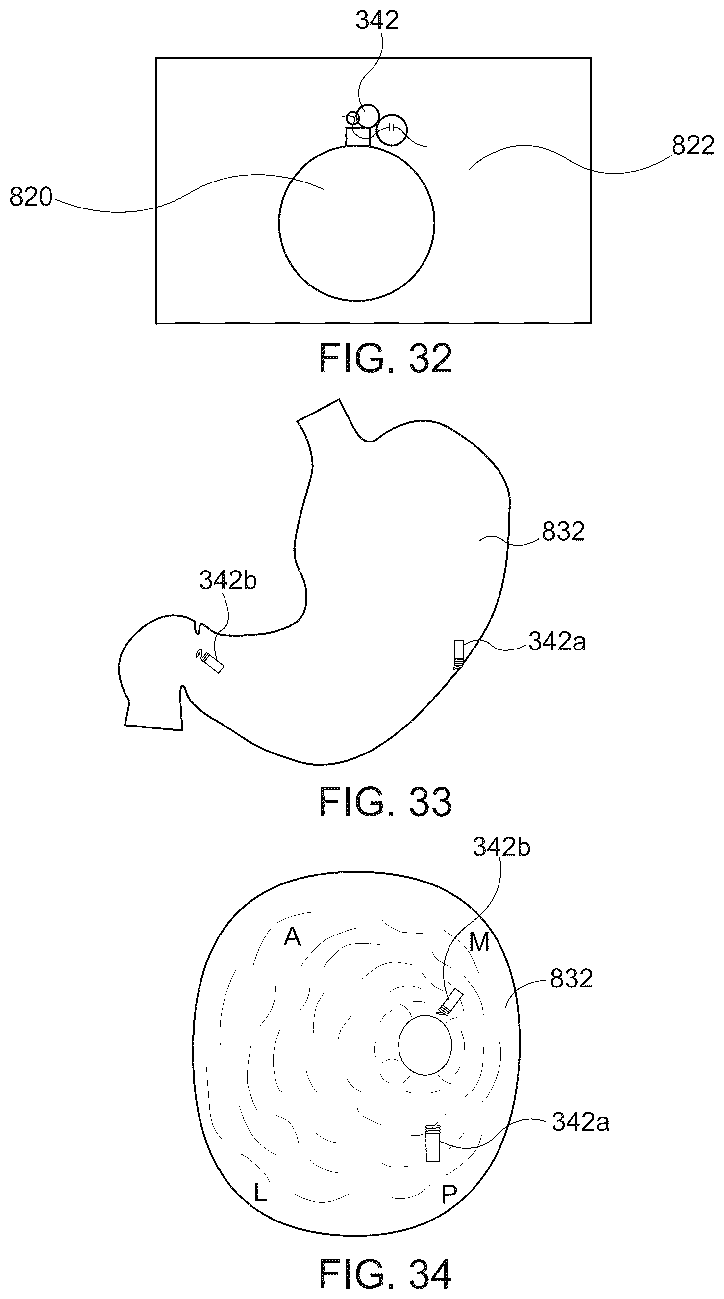 Patent US12376847 Figure 17 – Endoscopic tissue approximation system and methods