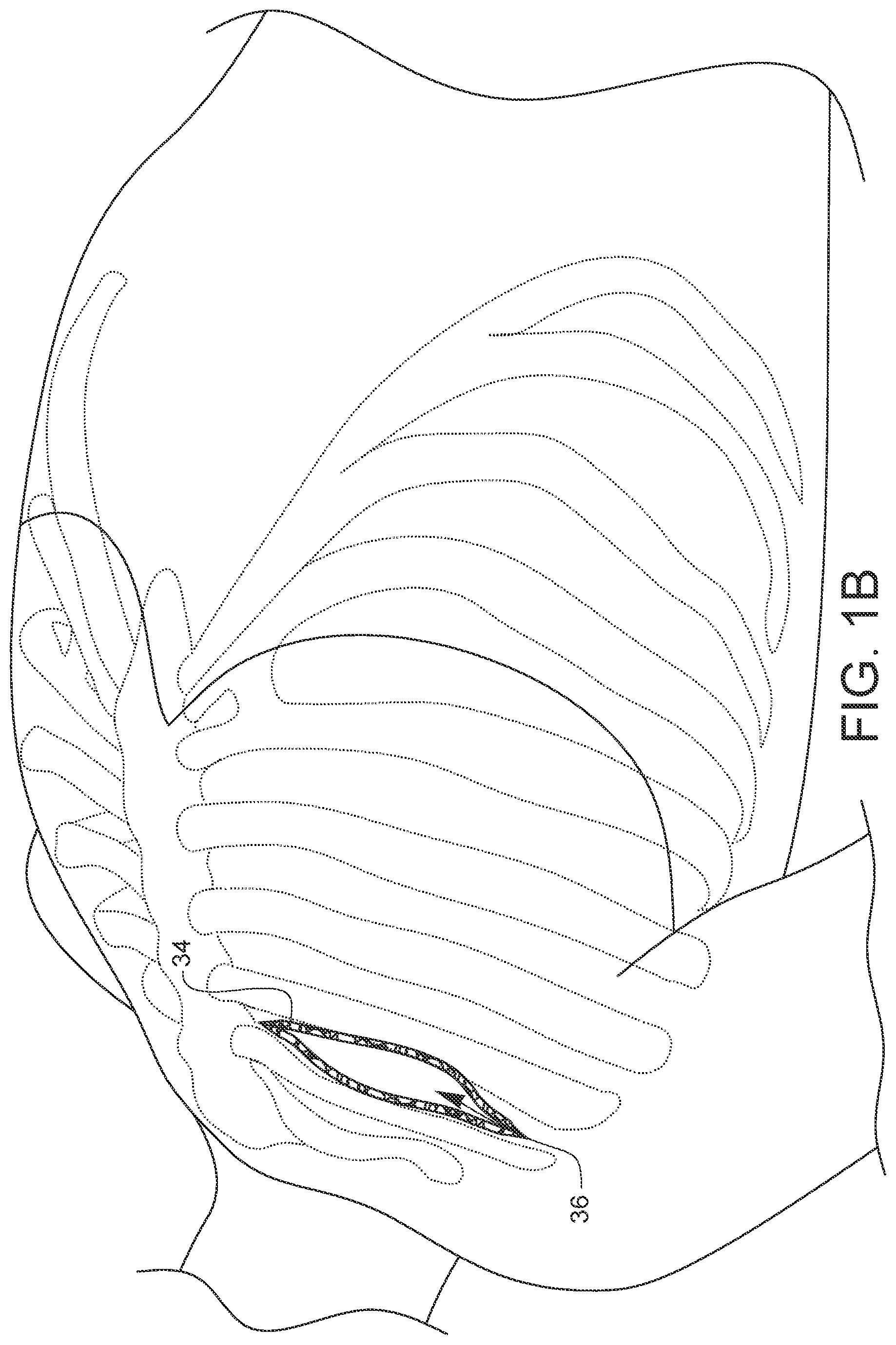 Patent US12376849 Figure 2 – Apparatus for suture management and methods thereof
