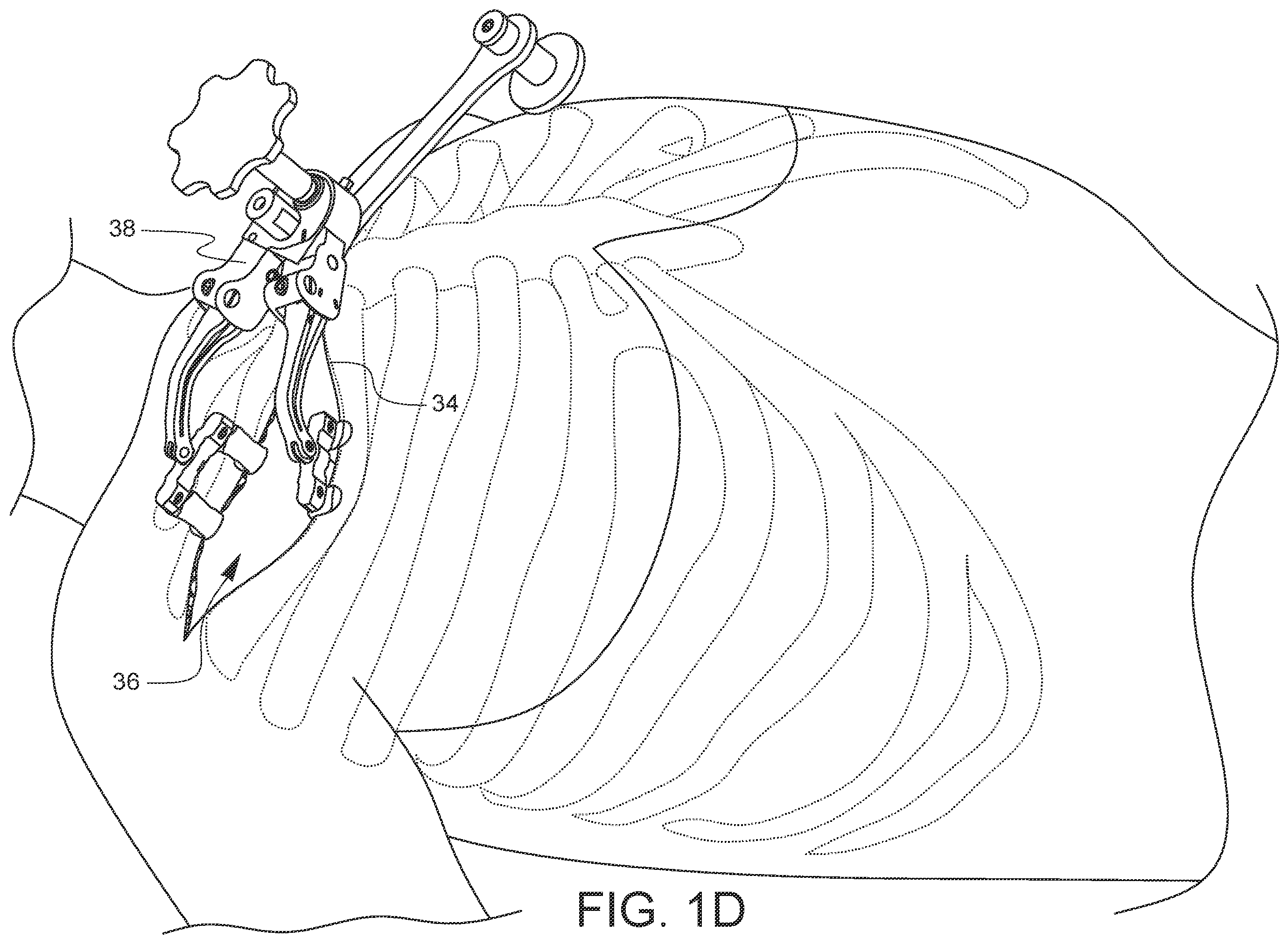 Patent US12376849 Figure 4 – Apparatus for suture management and methods thereof