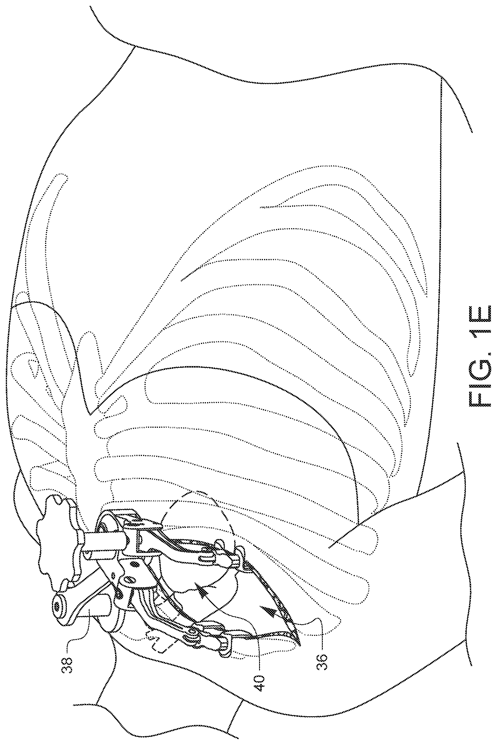 Patent US12376849 Figure 5 – Apparatus for suture management and methods thereof