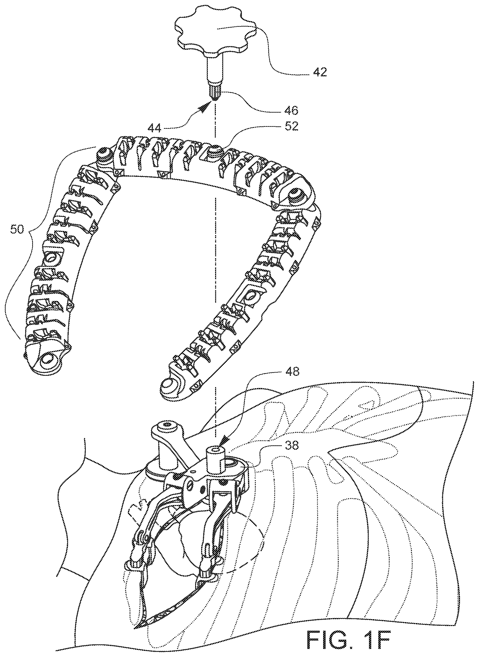 Patent US12376849 Figure 6 – Apparatus for suture management and methods thereof