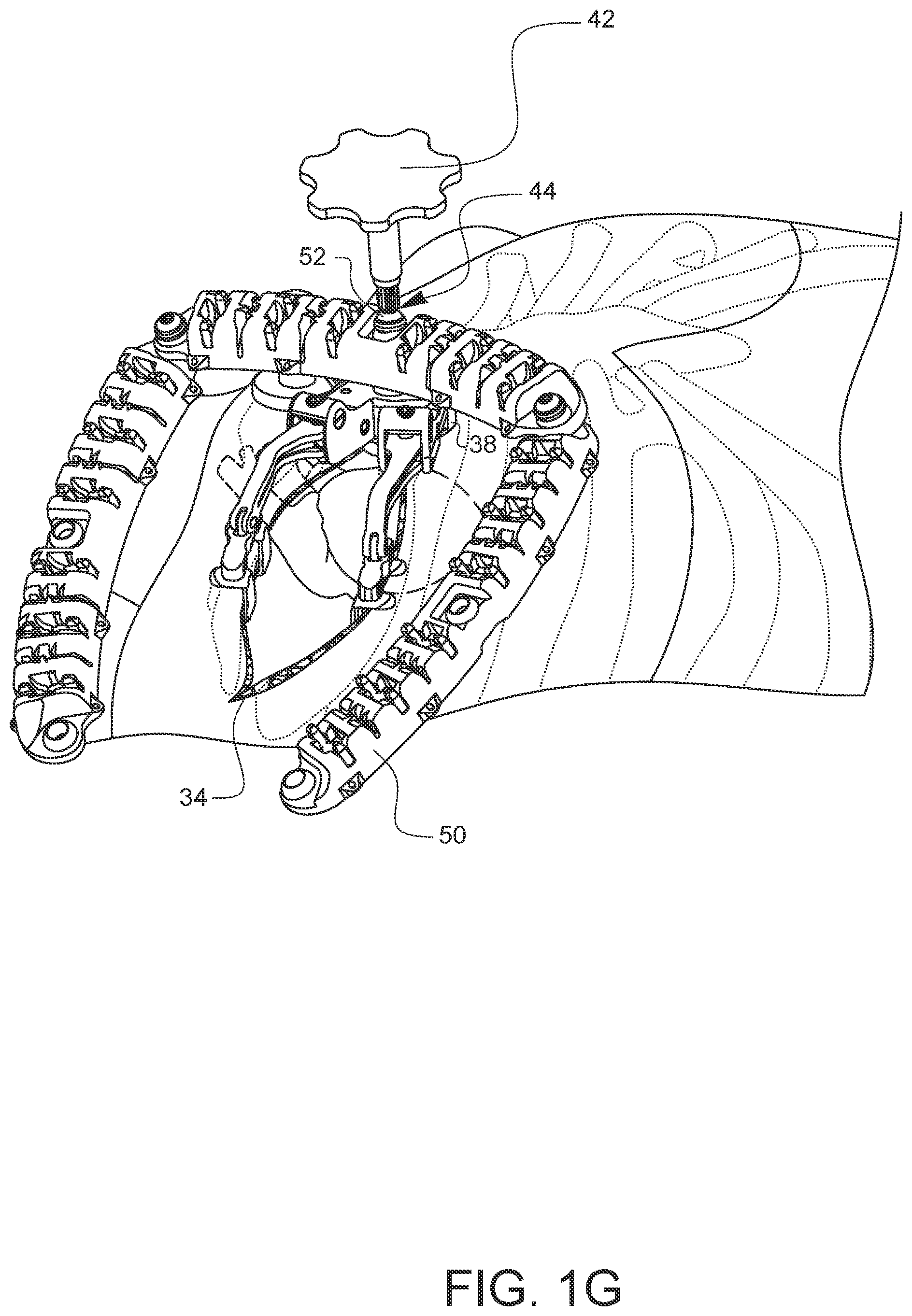 Patent US12376849 Figure 7 – Apparatus for suture management and methods thereof