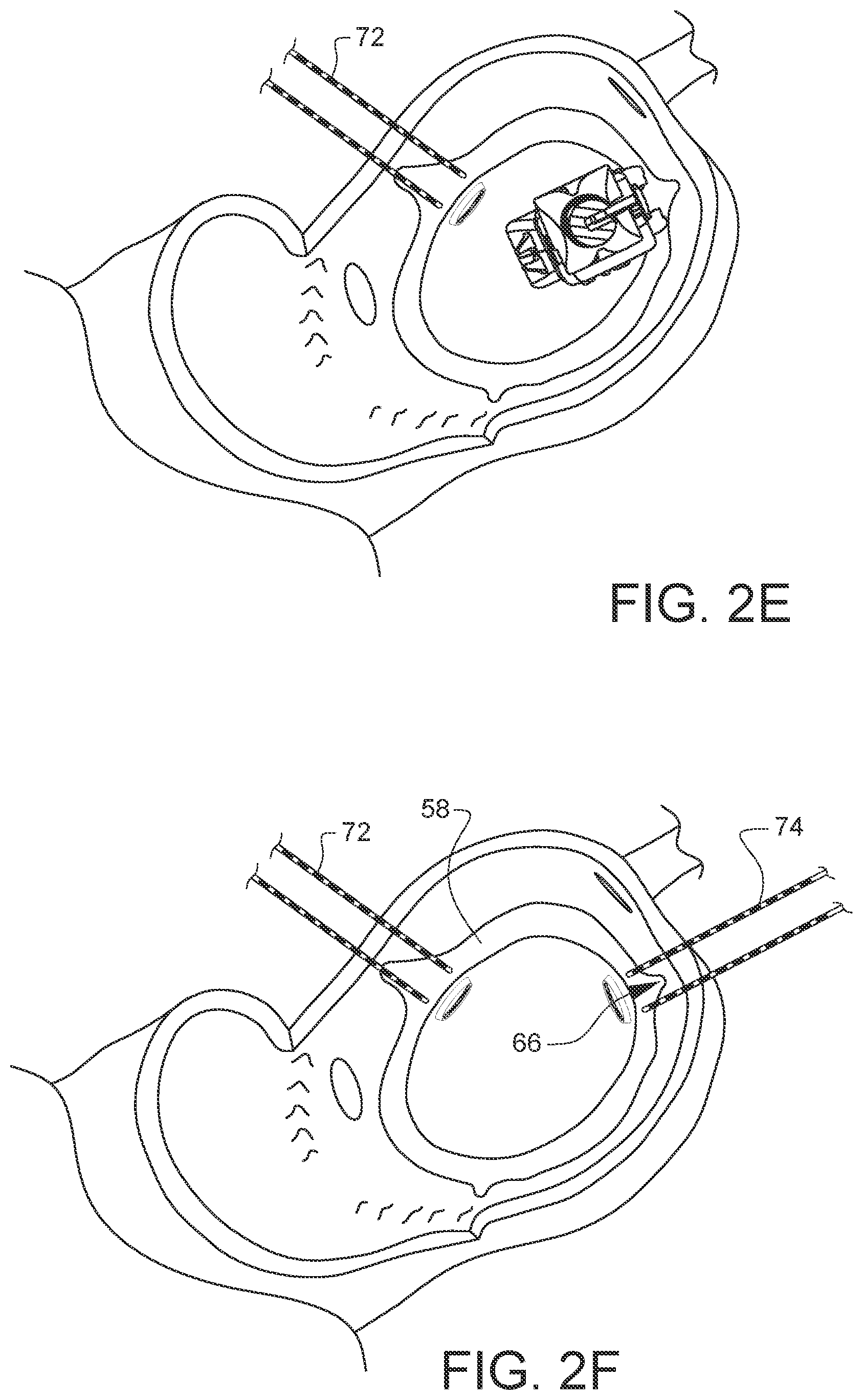 Patent US12376849 Figure 10 – Apparatus for suture management and methods thereof