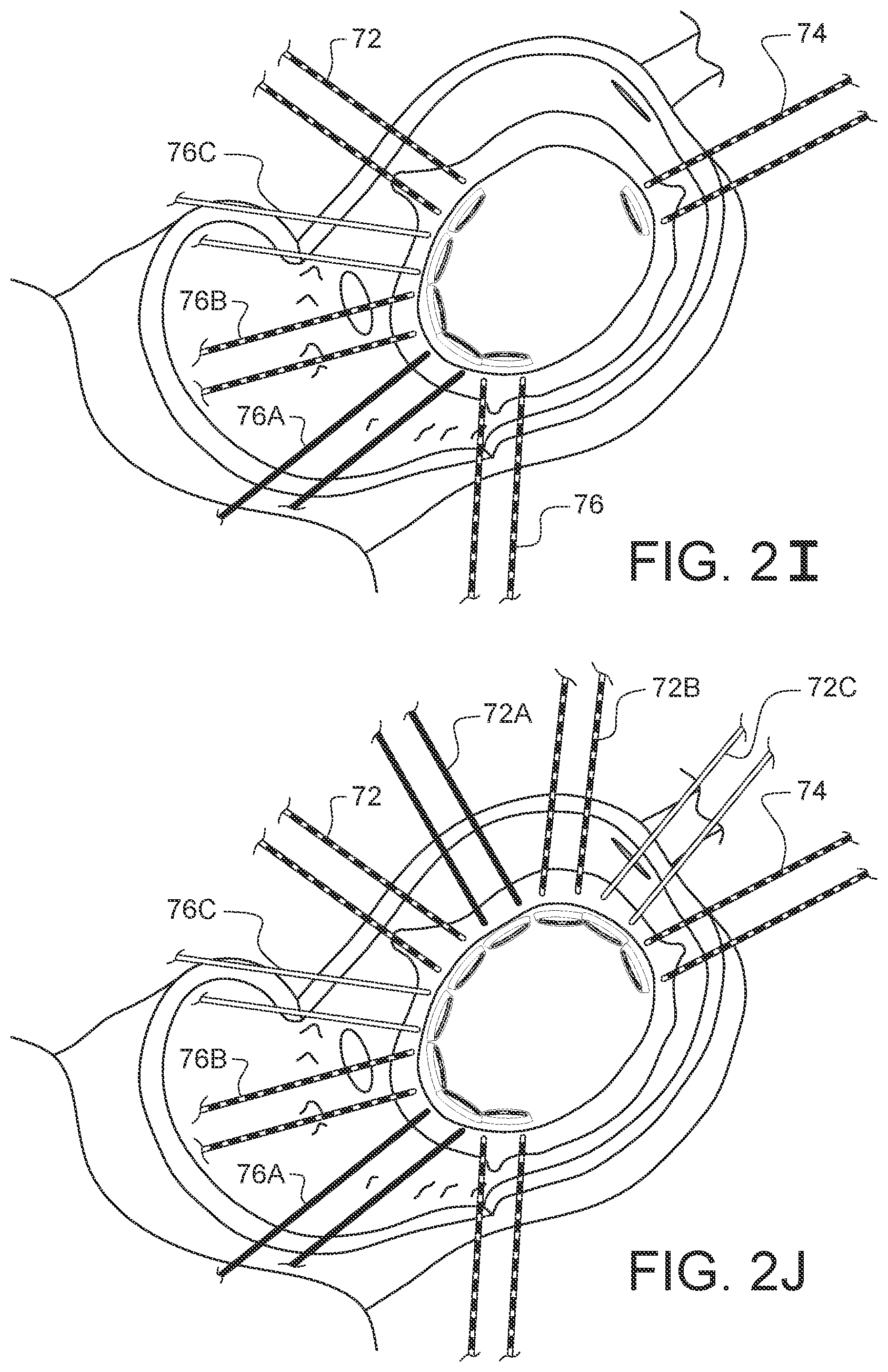 Patent US12376849 Figure 12 – Apparatus for suture management and methods thereof