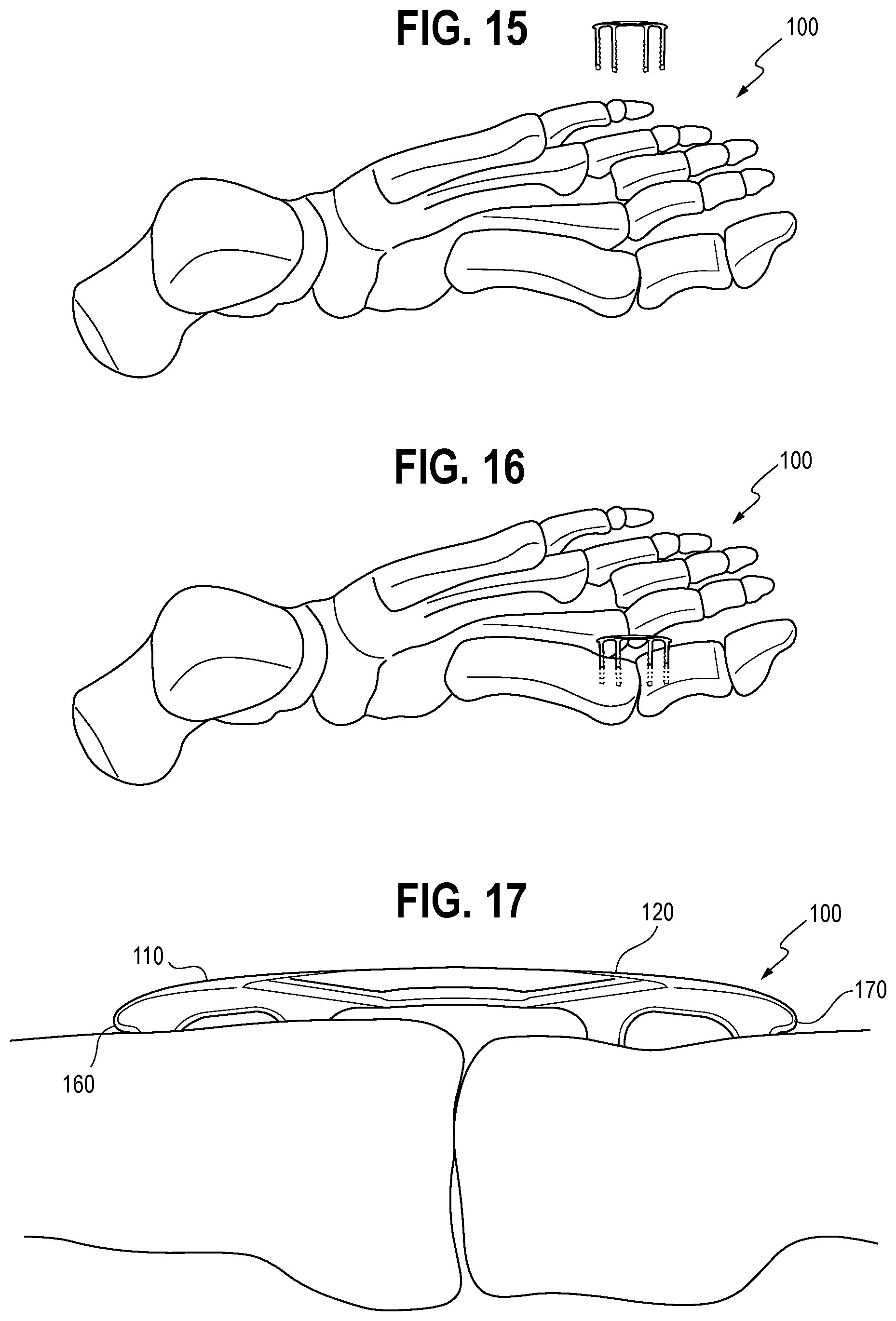 Patent US12376850 Figure 8 – Surgical staple