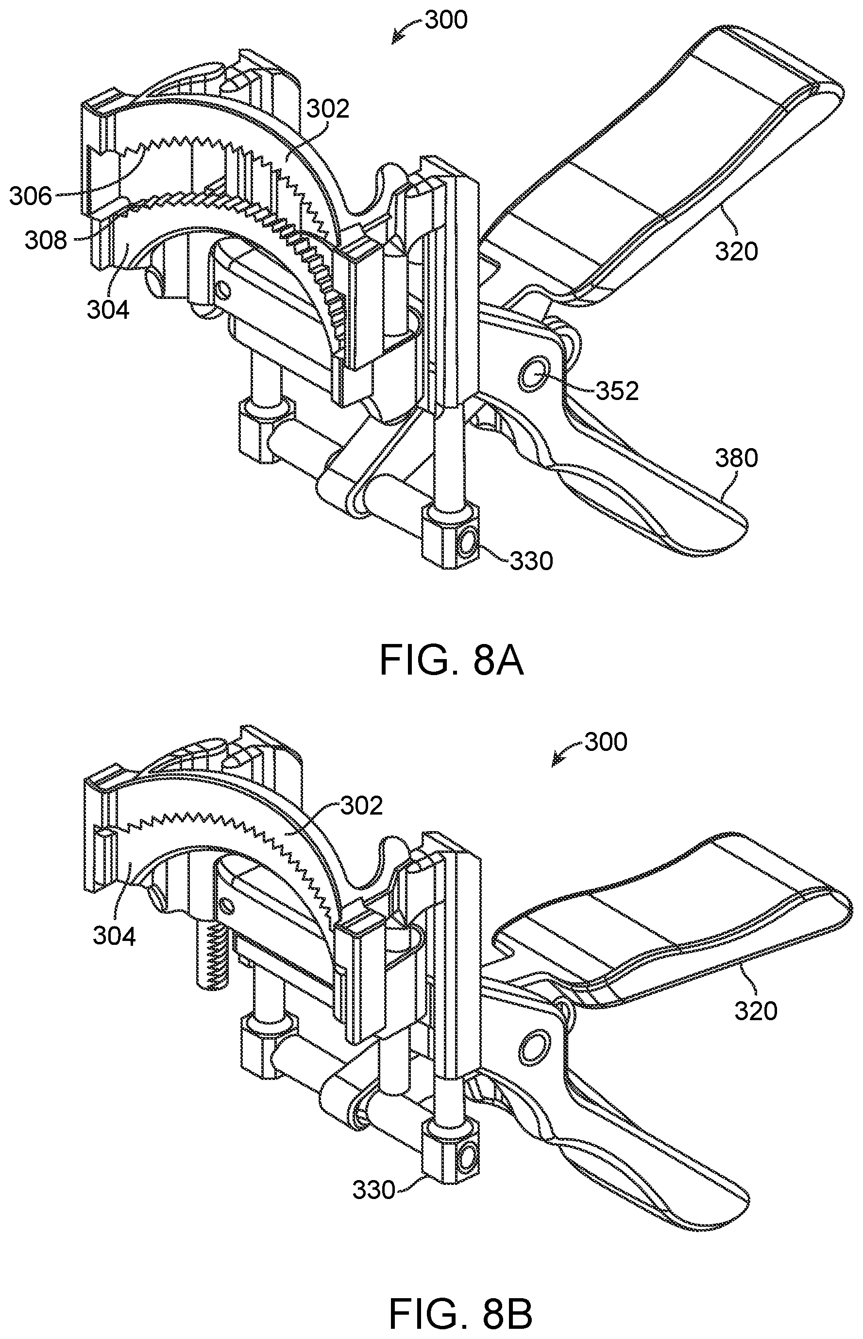 Patent US12376852 Figure 10 – Wound creation for excess skin removal and closure systems and methods
