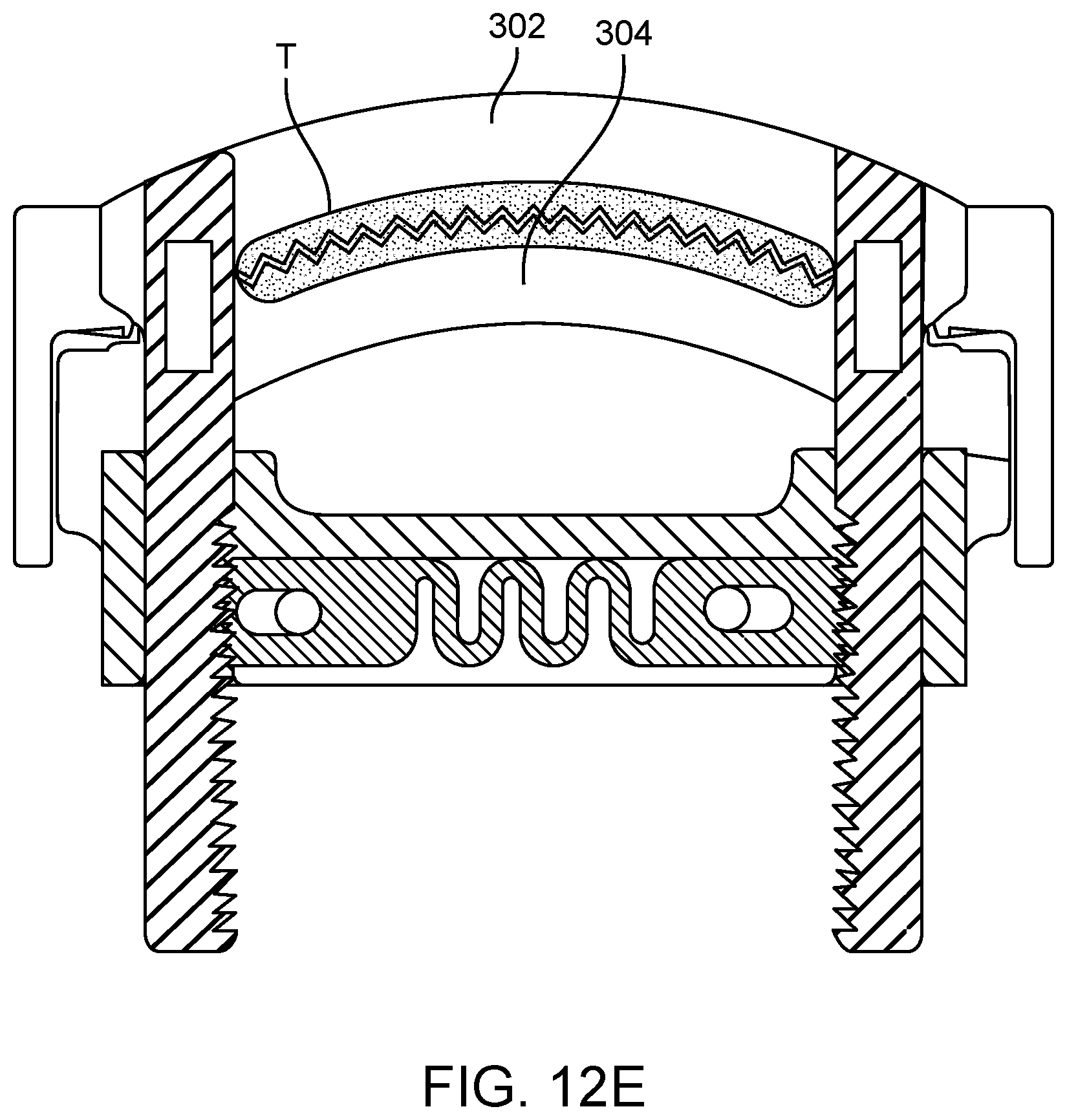 Patent US12376852 Figure 15 – Wound creation for excess skin removal and closure systems and methods