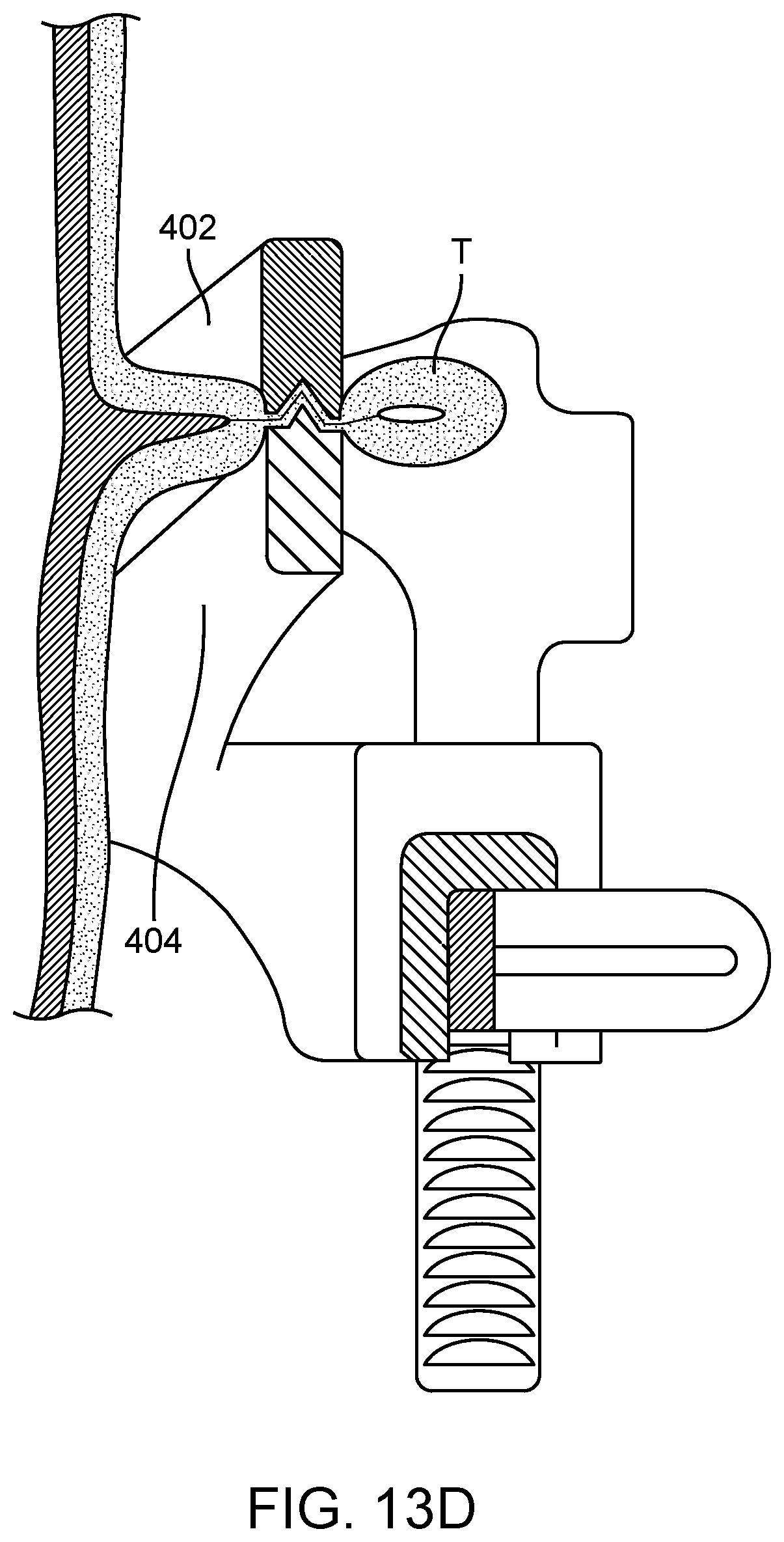 Patent US12376852 Figure 17 – Wound creation for excess skin removal and closure systems and methods