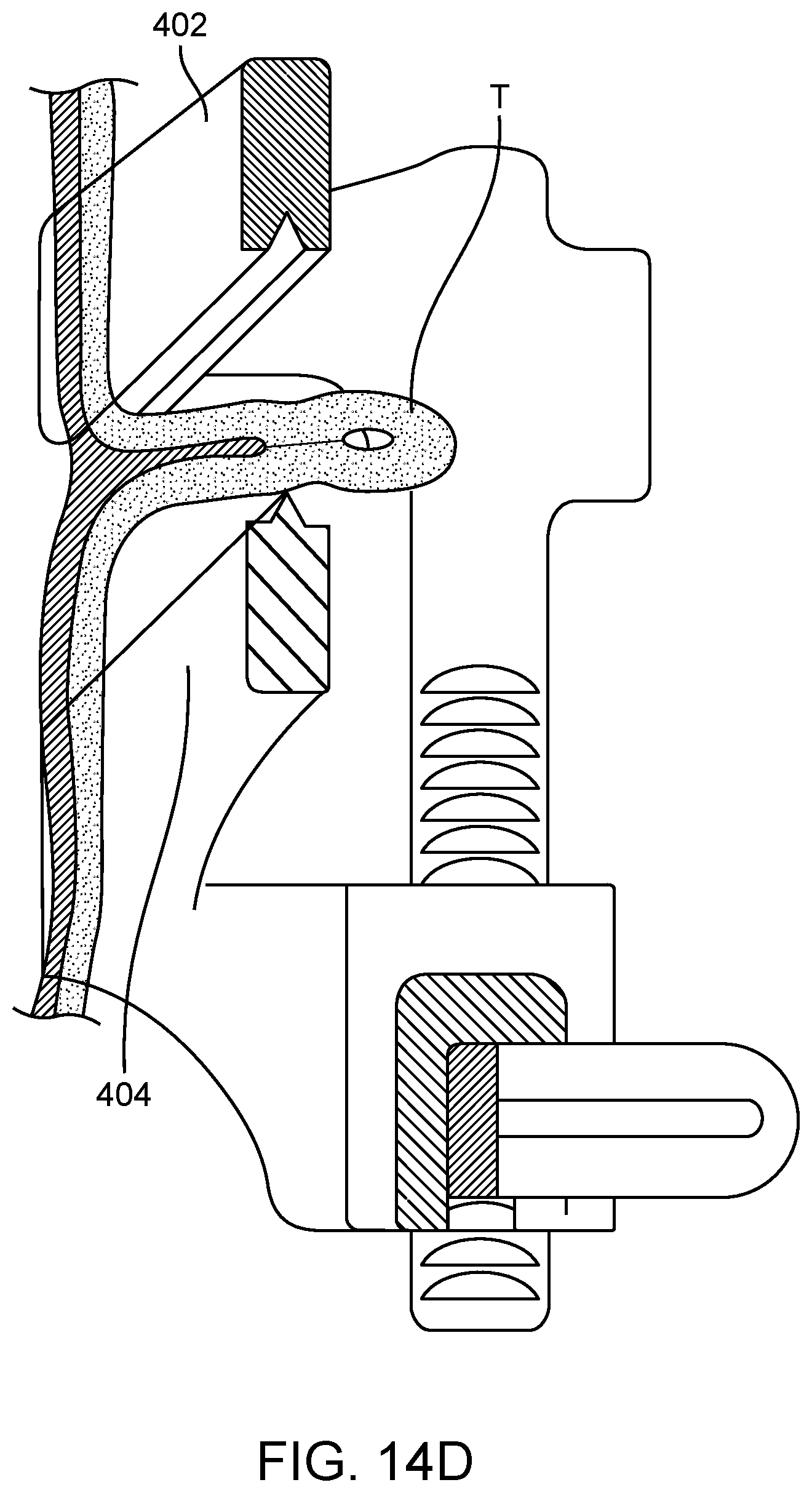 Patent US12376852 Figure 19 – Wound creation for excess skin removal and closure systems and methods
