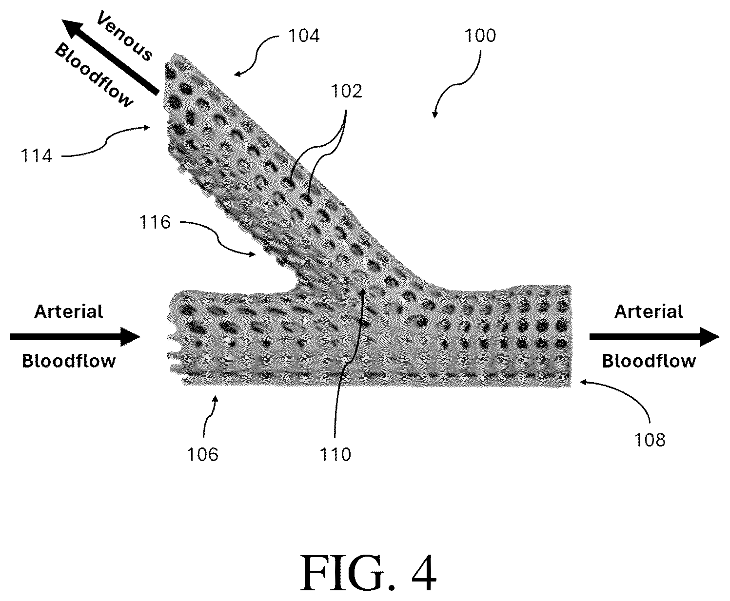 Patent US12376856 Figure 4 – Synthetic perivascular wrap
