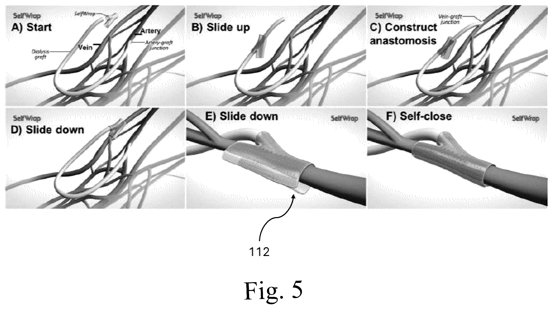 Patent US12376856 Figure 5 – Synthetic perivascular wrap