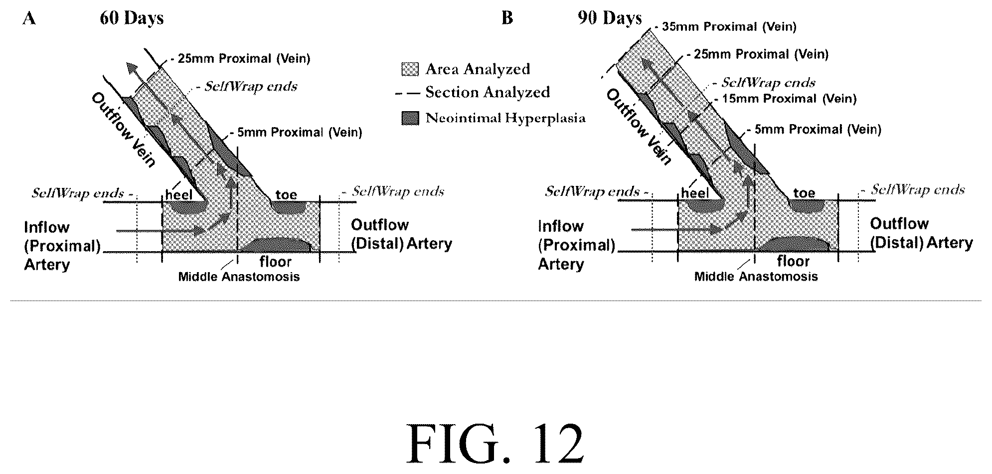 Patent US12376856 Figure 12 – Synthetic perivascular wrap