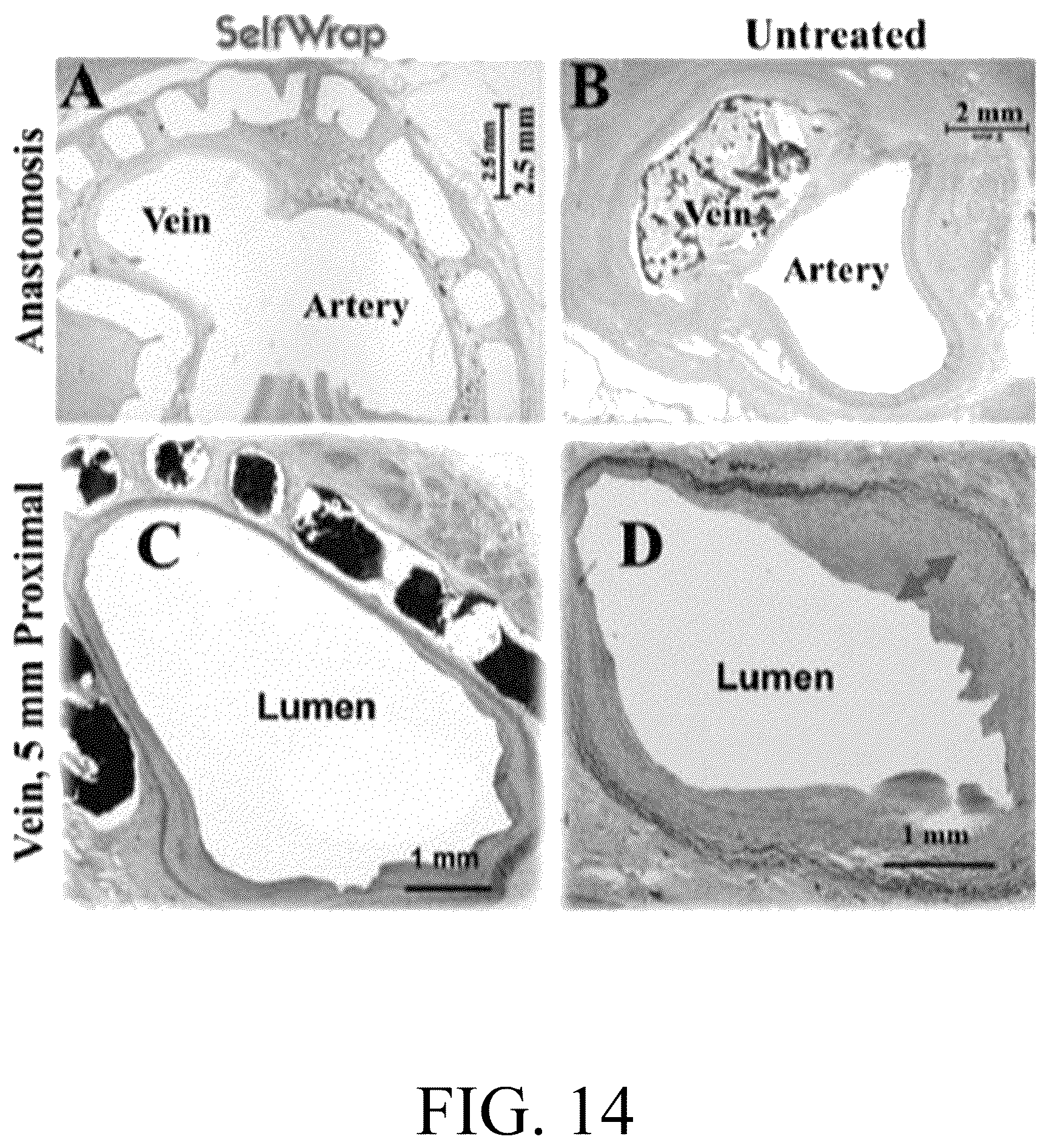 Patent US12376856 Figure 14 – Synthetic perivascular wrap