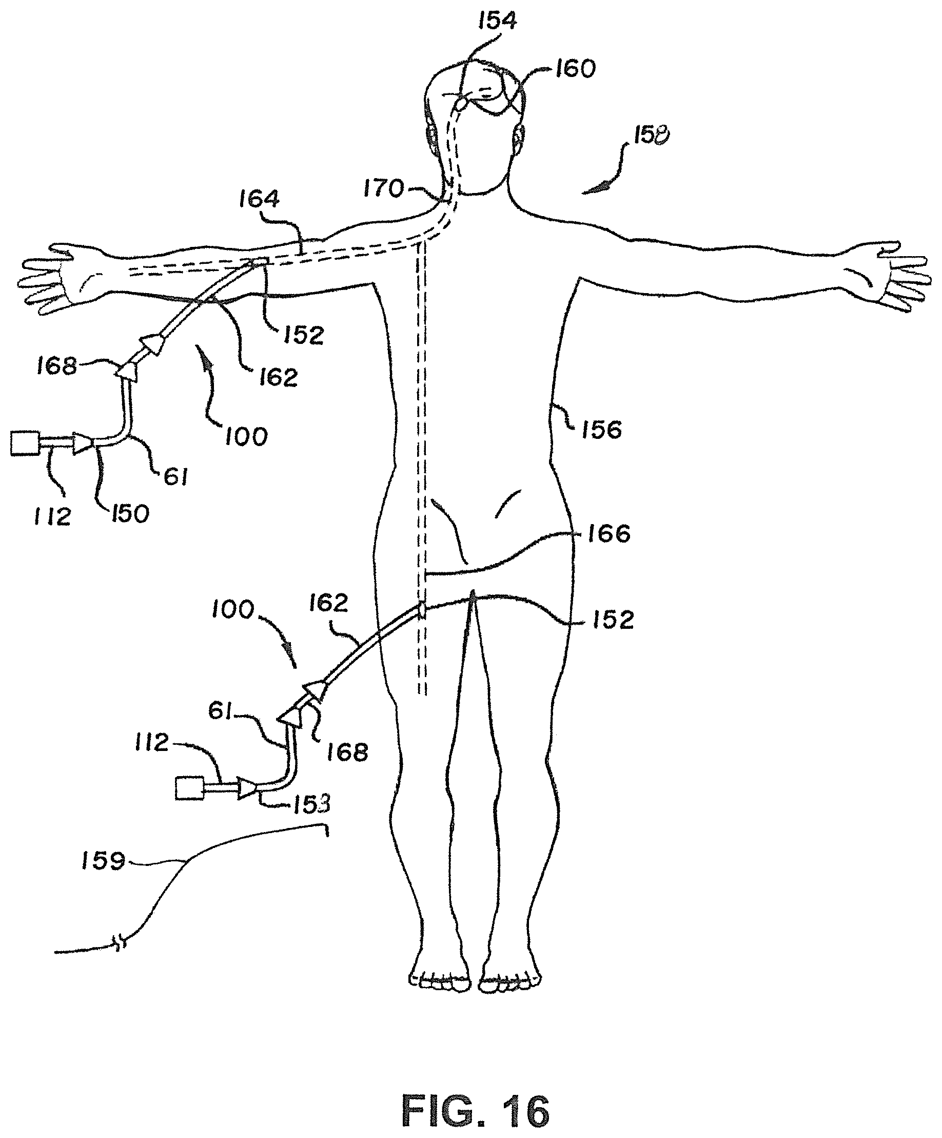 Patent US12376858 Figure 11 – Delivery and detachment systems and methods for vascular implants