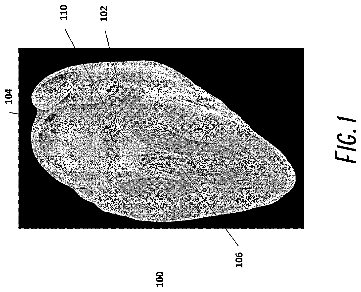 Patent US12376861 Figure 1 – Devices and methods for excluding the left atrial appendage