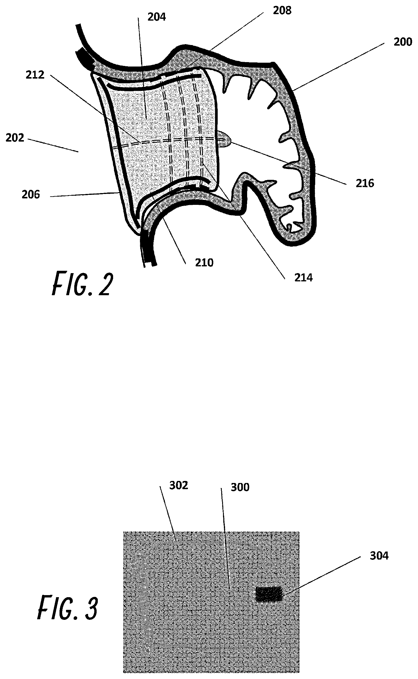 Patent US12376861 Figure 2 – Devices and methods for excluding the left atrial appendage