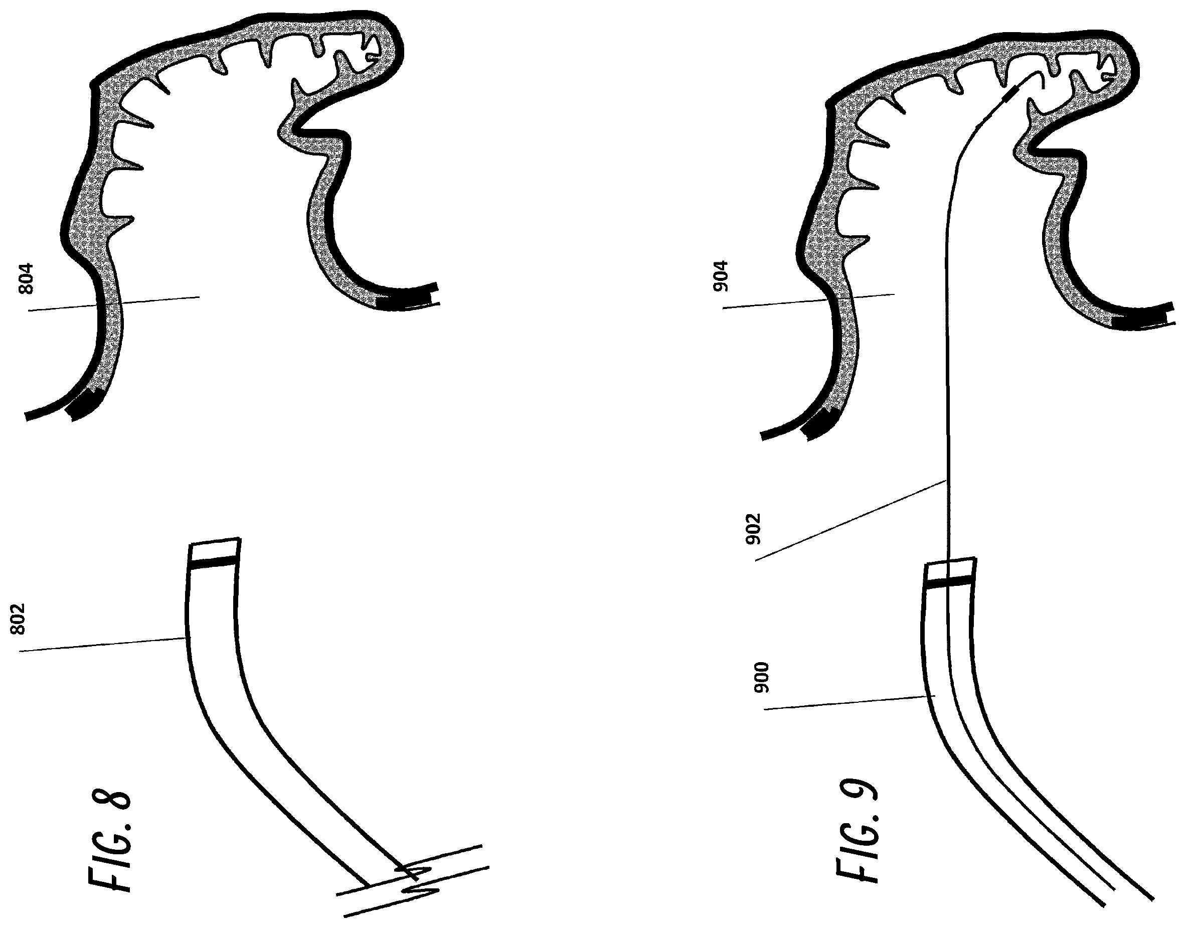 Patent US12376861 Figure 5 – Devices and methods for excluding the left atrial appendage