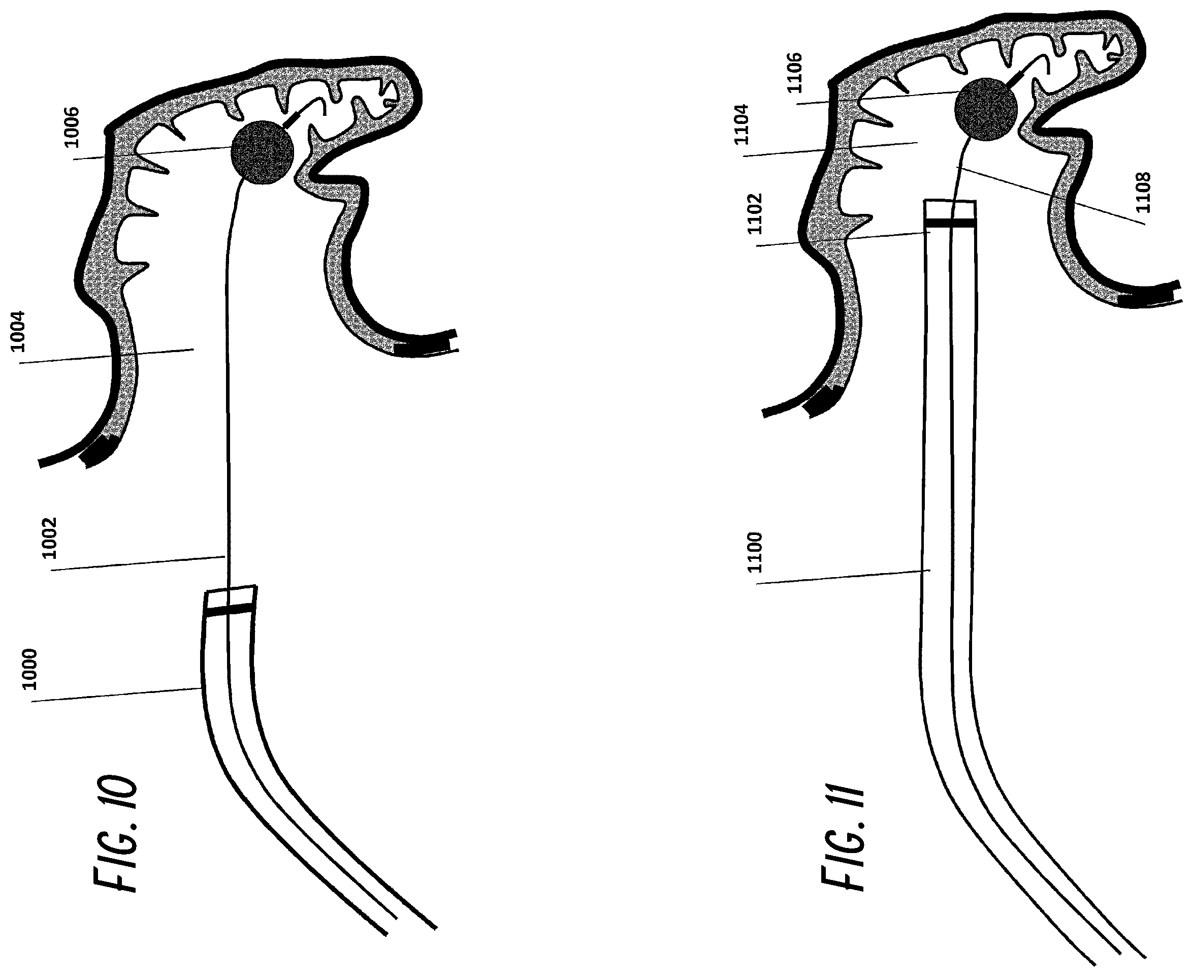 Patent US12376861 Figure 6 – Devices and methods for excluding the left atrial appendage