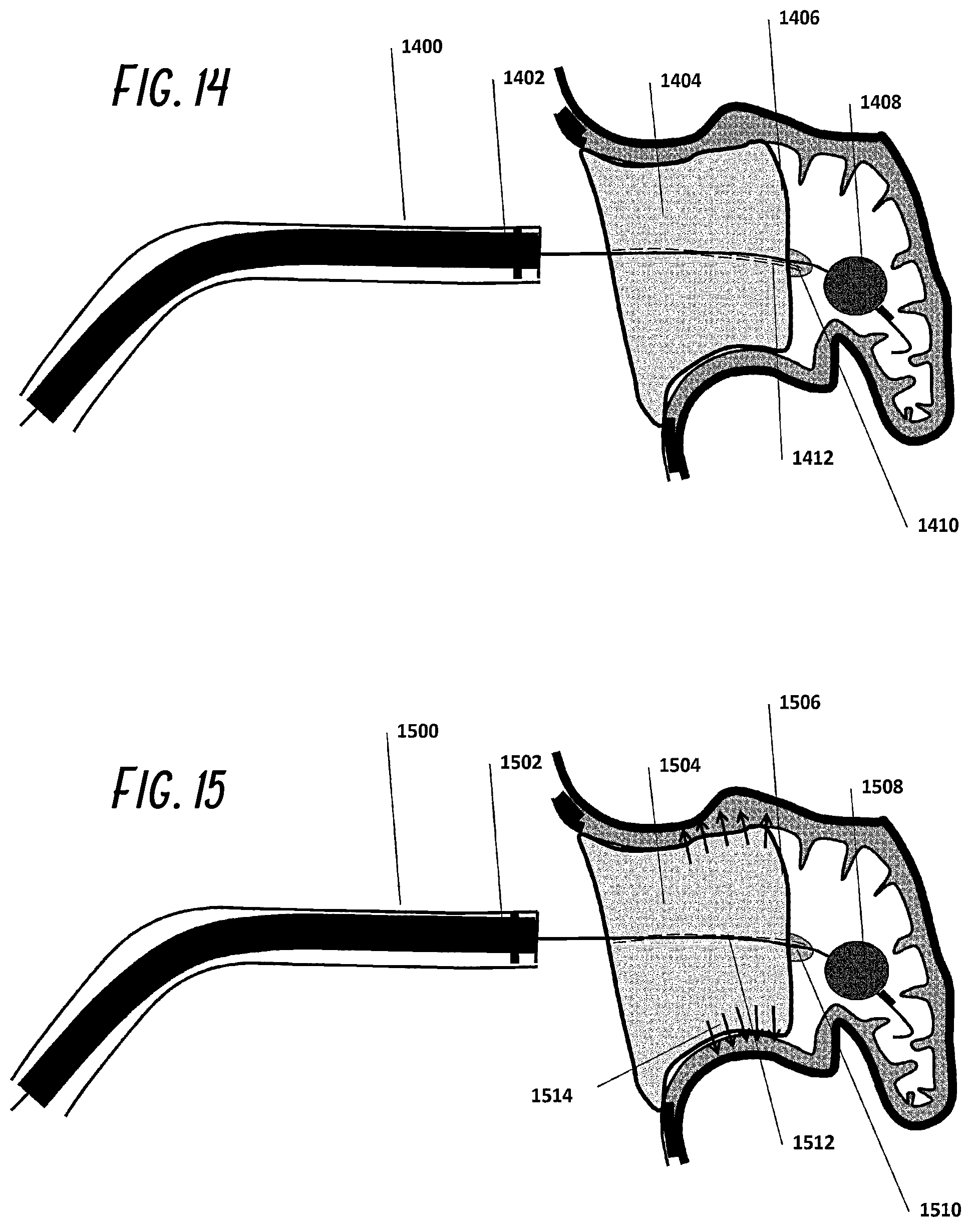 Patent US12376861 Figure 8 – Devices and methods for excluding the left atrial appendage