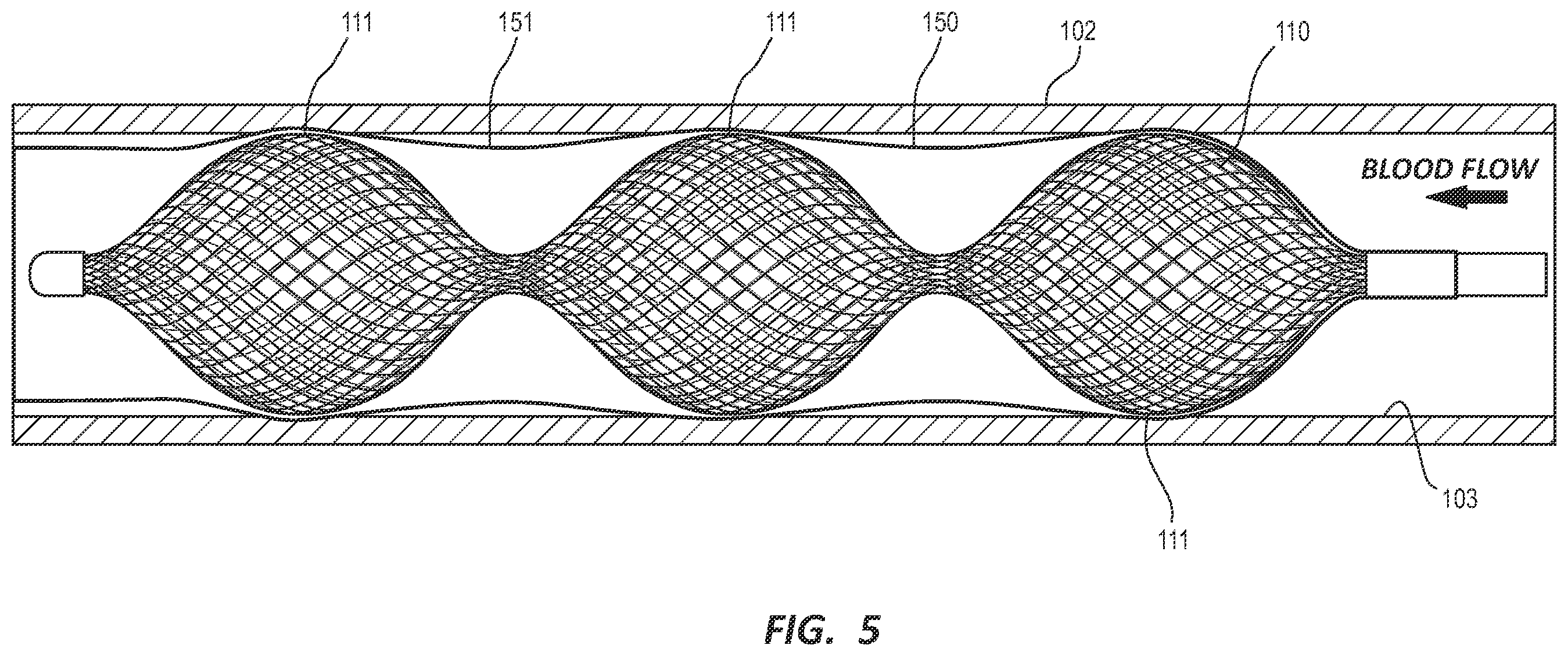 Patent US12376862 Figure 6 – Covered vascular plug