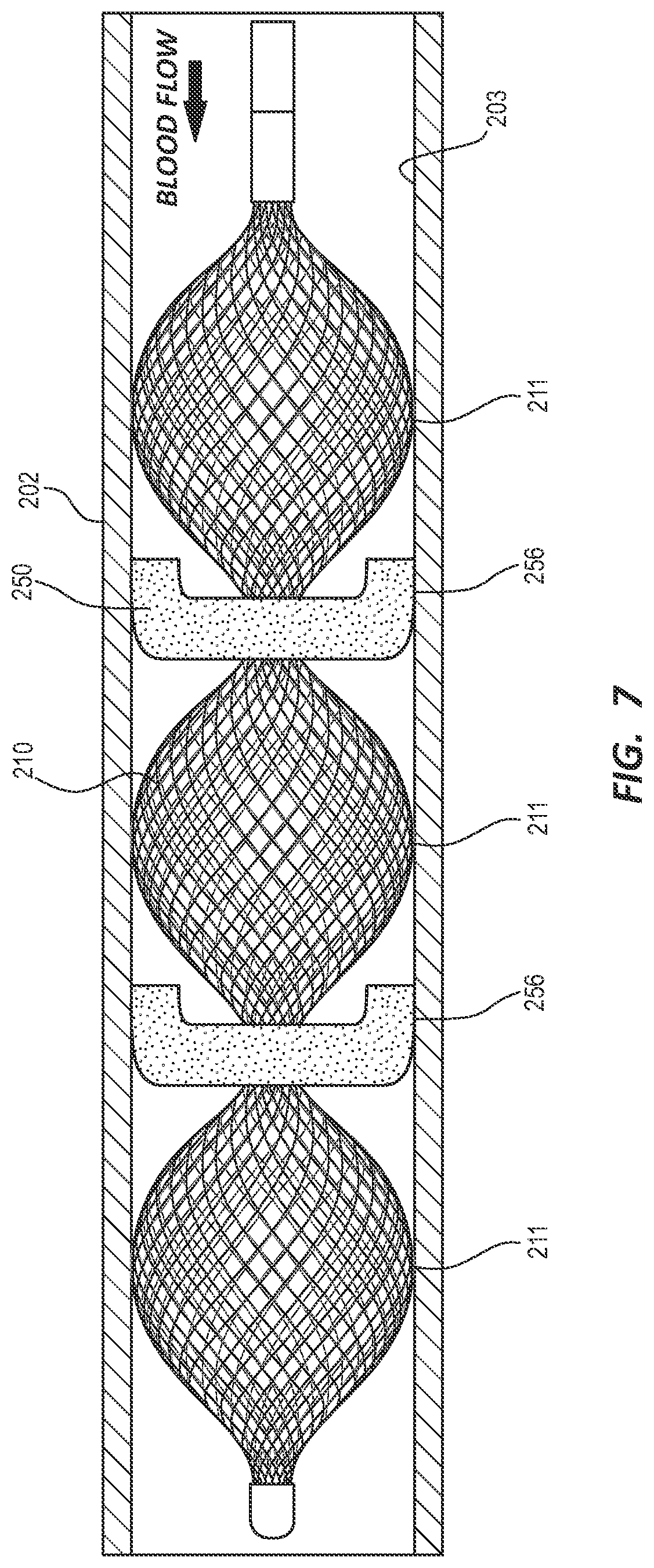 Patent US12376862 Figure 8 – Covered vascular plug