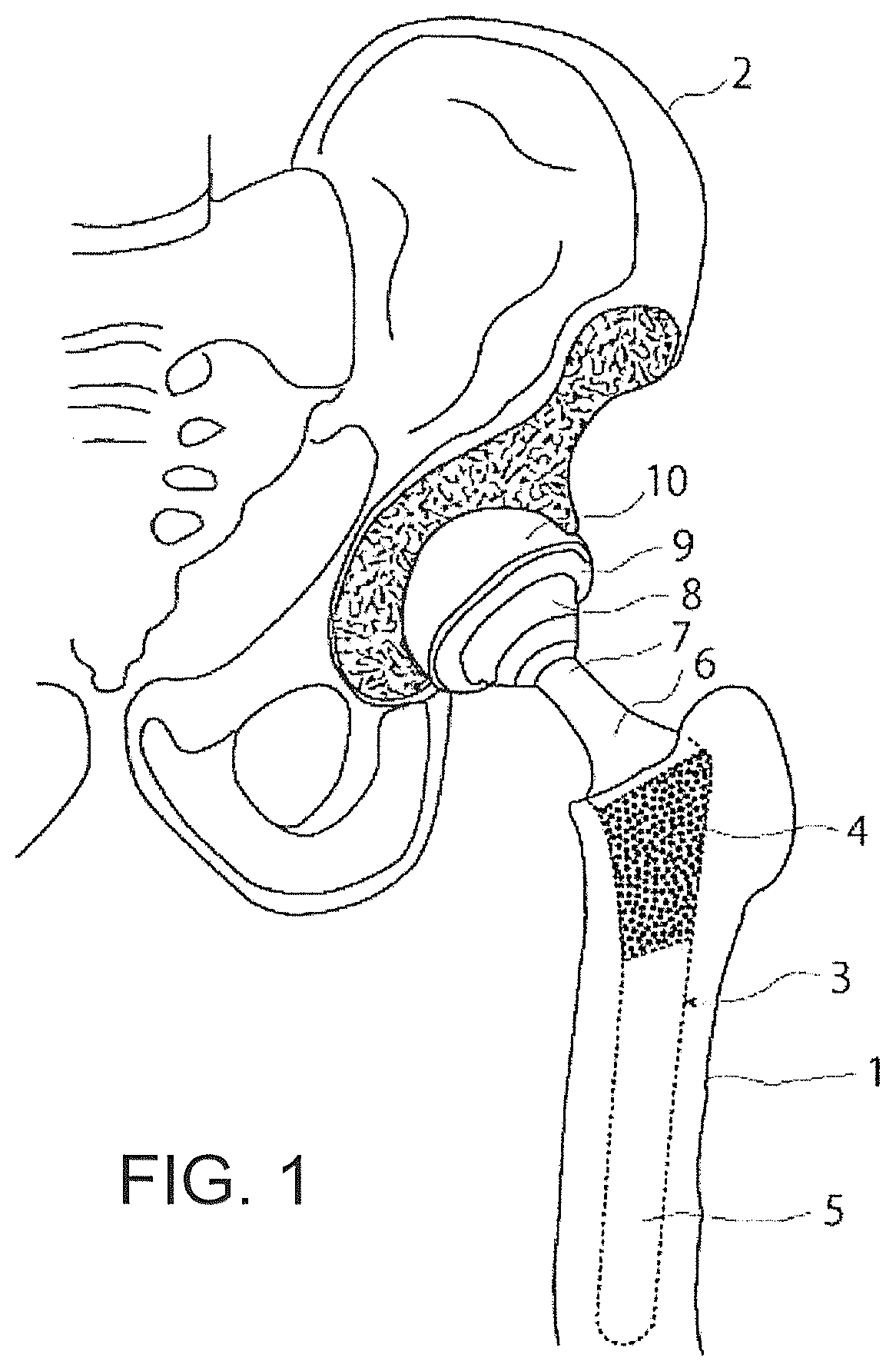 Patent US12376866 Figure 1 – Thin-blade chisel system